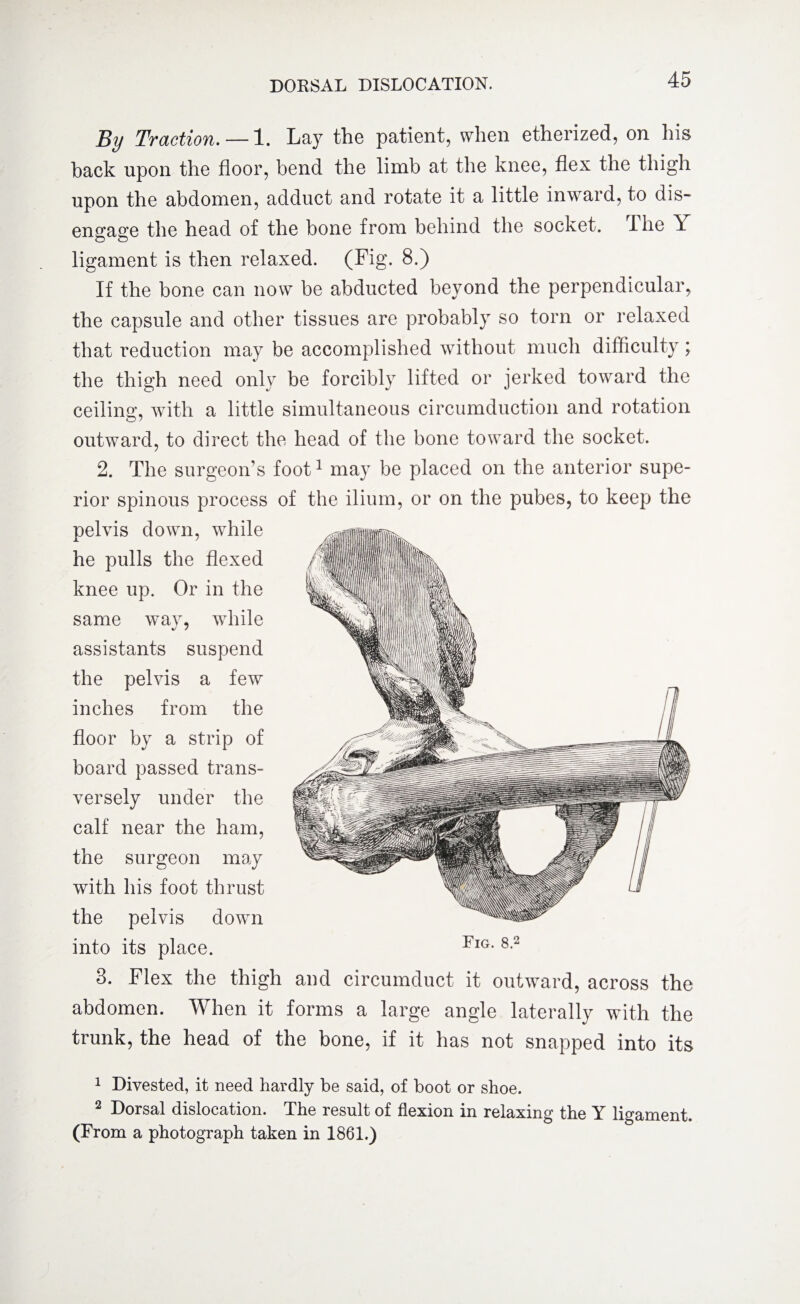 By Traction. — 1. Lay the patient, when etherized, on his hack upon the floor, bend the limb at the knee, flex the thigh upon the abdomen, adduct and rotate it a little inward, to dis¬ engage the head of the bone from behind the socket. The Y ligament is then relaxed. (Fig. 8.) If the bone can now be abducted beyond the perpendicular, the capsule and other tissues are probably so torn or relaxed that reduction may be accomplished without much difficulty; the thigh need only be forcibly lifted or jerked toward the ceiling*, with a little simultaneous circumduction and rotation outward, to direct the head of the bone toward the socket. 2. The surgeon's foot1 may be placed on the anterior supe¬ rior spinous process of the ilium, or on the pubes, to keep the pelvis down, wflflle he pulls the flexed knee up. Or in the same way, while assistants suspend the pelvis a few inches from the floor by a strip of board passed trans¬ versely under the calf near the ham, the surgeon may with his foot thrust the pelvis down into its place. 3. Flex the thigh and circumduct it outward, across the abdomen. When it forms a large angle laterally with the trunk, the head of the bone, if it has not snapped into its Fig. 8.2 1 Divested, it need hardly be said, of boot or shoe. 2 Dorsal dislocation. The result of flexion in relaxing the Y ligament. (From a photograph taken in 1861.)