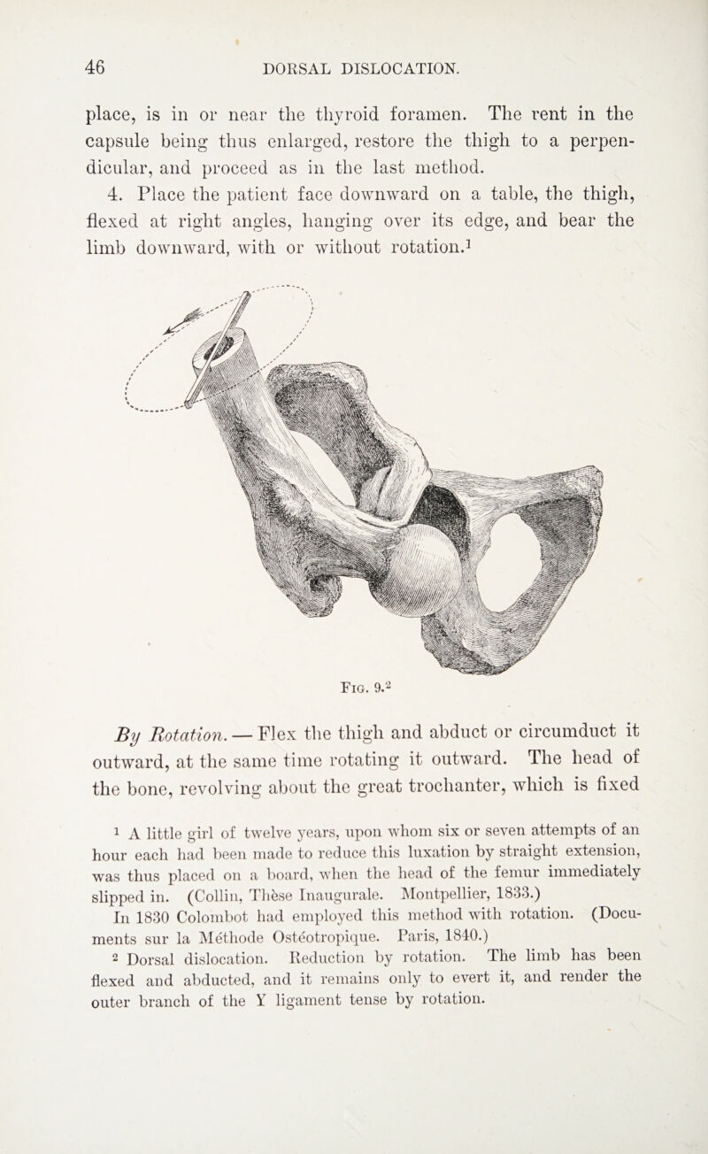 place, is in or near the thyroid foramen. The rent in the capsule being thus enlarged, restore the thigh to a perpen¬ dicular, and proceed as in the last method. 4. Place the patient face downward on a table, the thigh, flexed at right angles, hanging over its edge, and bear the limb downward, with or without rotation.1 2 Fig. 9.2 By Rotation. — Flex the thigh and abduct or circumduct it outward, at the same time rotating it outward. The head of the bone, revolving about the great trochanter, which is fixed 1 A little girl of twelve years, upon whom six or seven attempts of an hour each had been made to reduce this luxation by straight extension, was thus placed on a board, when the head of the femur immediately slipped in. (Colli n, These Inaugurale. Montpellier, 1833.) In 1830 Colombot had employed this method with rotation. (Docu¬ ments sur la Methode Osteotropique. Paris, 1840.) 2 Dorsal dislocation. Reduction by rotation. The limb has been flexed and abducted, and it remains only to evert it, and render the outer branch of the Y ligament tense by rotation.