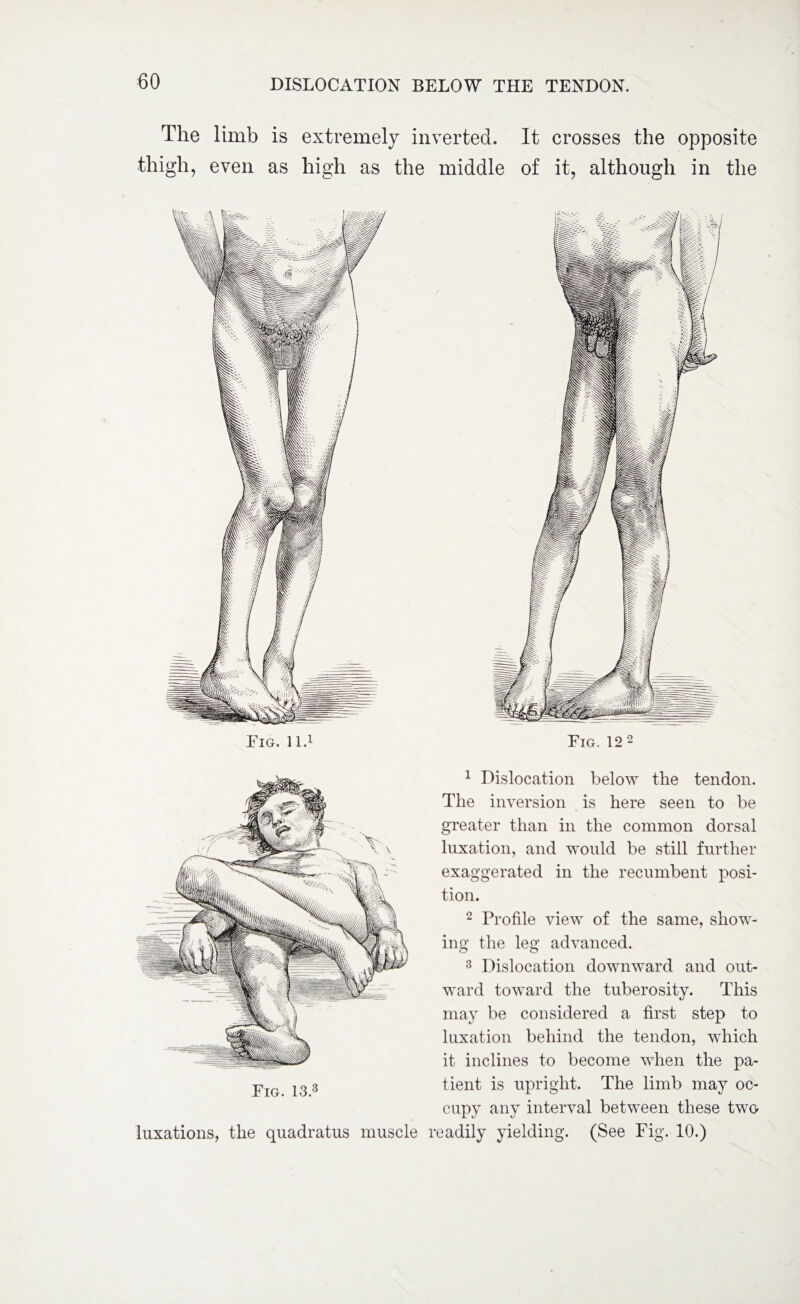 The limb is extremely inverted. It crosses the opposite thigh, even as high as the middle of it, although in the Fig. 11.1 Fig. 12 2 Fig. 13.3 luxations, the quadratus muscle r 1 Dislocation below the tendon. The inversion is here seen to be greater than in the common dorsal luxation, and would be still further exaggerated in the recumbent posi¬ tion. 2 Profile view of the same, show¬ ing the leg advanced. 3 Dislocation downward and out¬ ward toward the tuberosity. This may be considered a first step to luxation behind the tendon, which it inclines to become when the pa¬ tient is upright. The limb may oc¬ cupy any interval between these two eadily yielding. (See Fig. 10.)