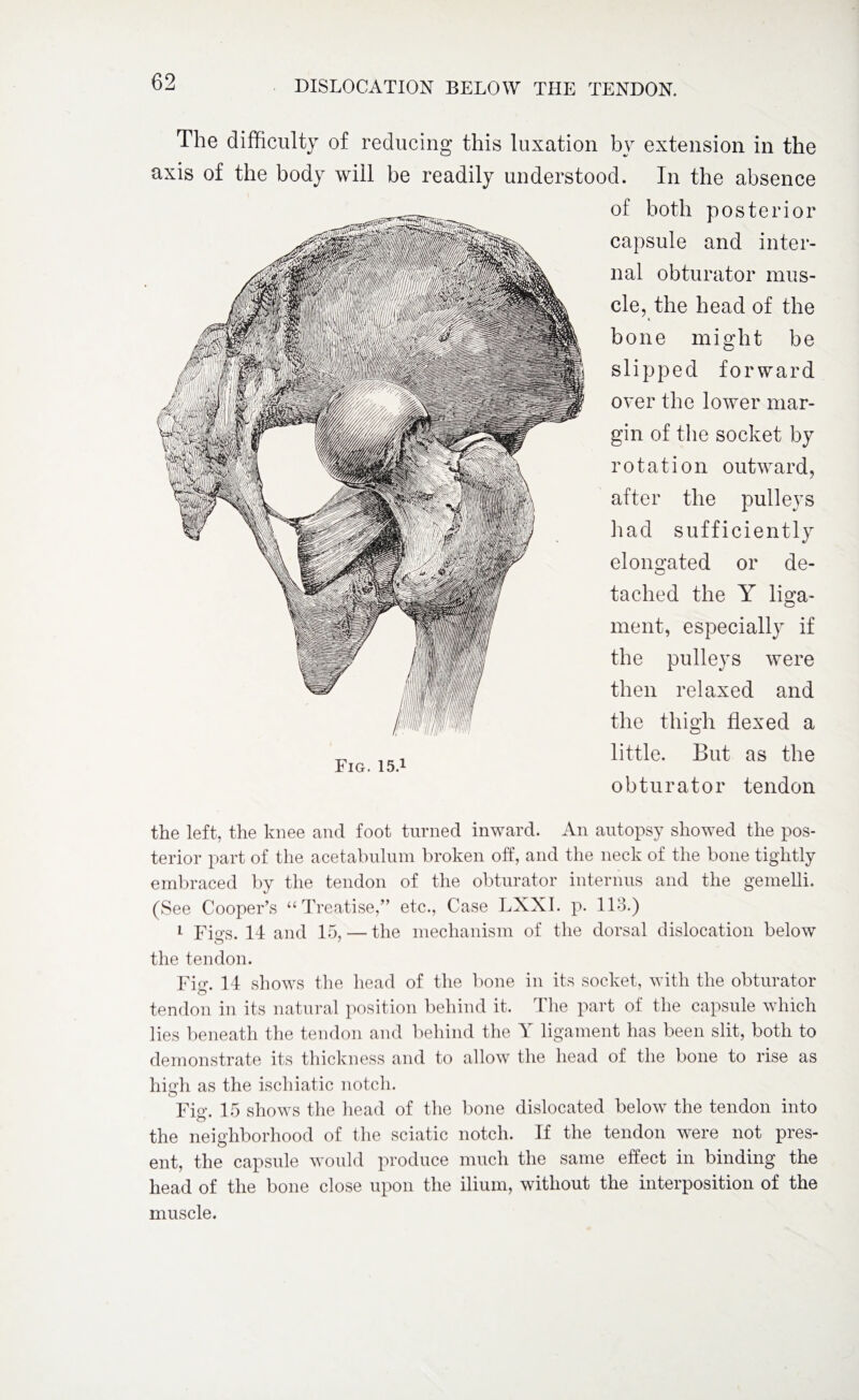 The difficulty of reducing this luxation by extension in the axis of the body will be readily understood. In the absence of both posterior capsule and inter¬ nal obturator mus¬ cle, the head of the bone might be slipped forward over the lower mar¬ gin of the socket by rotation outward, after the pulleys had sufficiently elongated or de¬ tached the Y liga¬ ment, especially if the pulleys were then relaxed and the thigh flexed a little. But as the obturator tendon the left, the knee and foot turned inward. An autopsy showed the pos¬ terior part of the acetabulum broken off, and the neck of the bone tightly embraced by the tendon of the obturator interims and the gemelli. (See Cooper’s “ Treatise,” etc., Case LXXI. p. 113.) 1 Fms. 14 and 15, — the mechanism of the dorsal dislocation below u the tendon. Fig. 14 shows the head of the bone in its socket, with the obturator tendon in its natural position behind it. The part of the capsule which lies beneath the tendon and behind the Y ligament has been slit, both to demonstrate its thickness and to allow the head of the bone to rise as high as the ischiatic notch. Fig. 15 shows the head of the bone dislocated below the tendon into the neighborhood of the sciatic notch. If the tendon were not pres¬ ent, the capsule would produce much the same effect in binding the head of the bone close upon the ilium, without the interposition of the muscle.