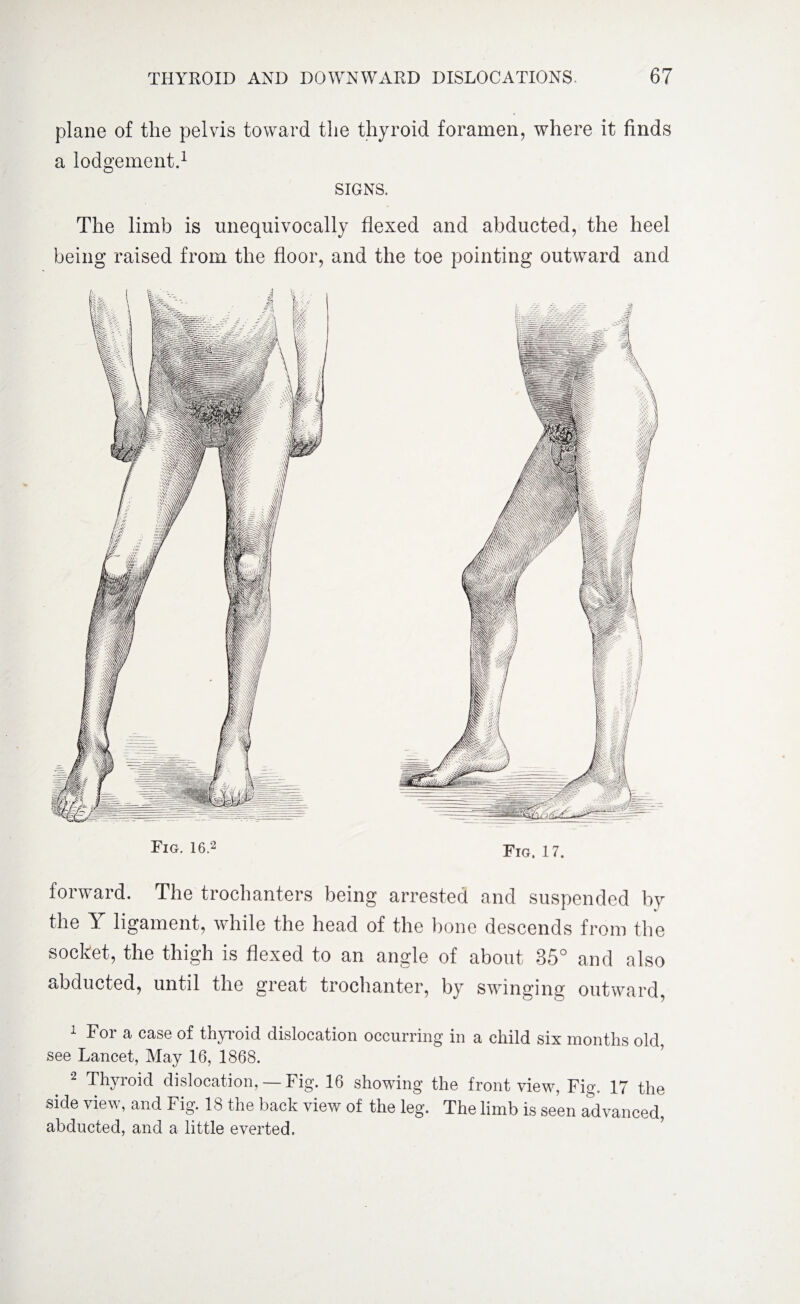 Fig. 16.2 Fig. 17. forward. The trochanters being arrested and suspended by the Y ligament, while the head of the bone descends from the socket, the thigh is flexed to an angle of about 35° and also abducted, until the great trochanter, by swinging outward, 1 For a case of thyroid dislocation occurring in a child six months old, see Lancet, May 16, 1868. 2 Thyroid dislocation, — Fig. 16 showing the front view, Fig. 17 the side view, and Fig. 18 the back view of the leg. The limb is seen advanced, abducted, and a little everted. plane of the pelvis toward the thyroid foramen, where it finds a lodgement.1 2 SIGNS. The limb is unequivocally flexed and abducted, the heel being raised from the floor, and the toe pointing outward and