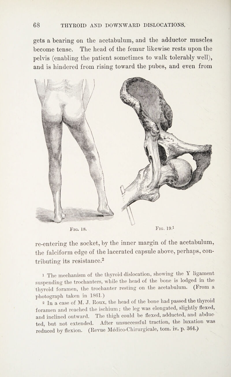 gets a bearing on the acetabulum, and the adductor muscles become tense. The head of the femur likewise rests upon the pelvis (enabling the patient sometimes to walk tolerably well), and is hindered from rising toward the pubes, and even from Fig. 18. Fig. 19.1 re-entering the socket, by the inner margin of the acetabulum, the falciform edge of the lacerated capsule above, perhaps, con¬ tributing its resistance.2 1 The mechanism of the thyroid dislocation, showing the Y ligament suspending the trochanters, while the head of the bone is lodged in the thyroid foramen, the trochanter resting on the acetabulum. (From a photograph taken in 1861.) 2 In a case of M. J. Roux, the head of the bone had passed the thyroid foramen and reached the ischium; the leg was elongated, slightly flexed, and inclined outward. The thigh could be flexed, adducted, and abduc¬ ted, but not extended. After unsuccessful traction, the luxation was reduced by flexion. (Revue Medico-Chirurgicale, tom. iv. p* 364.)