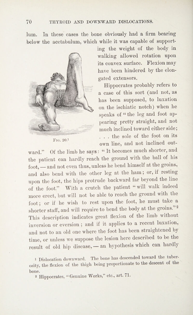 lum. In these cases the bone obviously had a firm bearing below the acetabulum, which while it was capable of support¬ ing the weight of the body in walking allowed rotation upon its convex surface. Flexion may have been hindered by the elon¬ gated extensors. Hippocrates probably refers to a case of this sort (and not, as has been supposed, to luxation on the ischiatic notch) when he speaks of “ the leg and foot ap¬ pearing pretty straight, and not much inclined toward either side; . . the sole of the foot on its Tig. 20.1 own line, and not inclined out- ward.” Of the limb he says: “ It becomes much shorter, and the patient can hardly reach the ground with the ball of his foot, — and not even thus, unless he bend himself at the groins, and also bend with the other leg at the ham; or, if resting upon the foot, the hips protrude backward far beyond the line of the foot.” With a crutch the patient “will walk indeed more erect, but will not be able to reach the ground with the foot; or if he wish to rest upon the foot, he must take a shorter staff, and will require to bend the body at the groins. ’2 This description indicates great flexion of the limb without inversion or eversion ; and if it applies to a recent luxation, and not to an old one where the foot has been straightened by time, or unless we suppose the lesion here described to be the result of old hip disease, — an hypothesis which can hardly 1 Dislocation downward. The bone has descended toward the tuber¬ osity, the flexion of the thigh being proportionate to the descent of the bone. 2 Hippocrates, “ Genuine Works,” etc., art. 71.