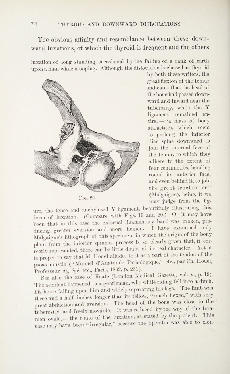 The obvious affinity and resemblance between these down¬ ward luxations, of which the thyroid is frequent and the others luxation of long standing, occasioned by the falling of a bank of earth upon a man while stooping. Although the dislocation is classed as thyroid by both these writers, the great flexion of the femur indicates that the head of the bone had passed down¬ ward and inward near the tuberosity, while the Y ligament remained en¬ tire,— “a mass of bony stalactites, which seem to prolong the inferior iliac spine downward to join the internal face of the femur, to which they adhere to the extent of four centimetres, bending round its anterior face, and even behind it, to join the great trochanter >> Fig. 22. (Malgaigne), being, if we may judge from the fig- ure, the tense and anchylosed Y ligament, beautifully illustrating this form of luxation. (Compare with Figs. 19 and 20.) Or it may have been that in this case the external ligamentary band was broken, pro¬ ducing greater eversion and more flexion. I have examined only Malgaigne’s lithograph of this specimen, in which the origin of the bony plate from the inferior spinous process is so clearly given that, if cor¬ rectly represented, there can be little doubt of its real character, let it is proper to say that M. ITouel alludes to it as a part of the tendon of the psoas muscle (“ Manuel d’Anatomie Fathologique,” etc., par Cli. Houel, Professeur Agrege, etc., Paris, 18(>2, p. 2ol). See also the case of Keate (London Medical Gazette, vol. x., p. 19). The accident happened to a gentleman, who while riding fell into a ditch, his horse falling upon him and widely separating his legs. 1 he limb was three and a half inches longer than its fellow, “ much flexed,” with very great abduction and eversion. The head of the bone was close to the tuberosity, and freely movable. It was reduced by the way of the fora¬ men ovaie,—the route of the luxation, as stated by the patient. This case may have been “ irregular,” because the operator was able to elon-