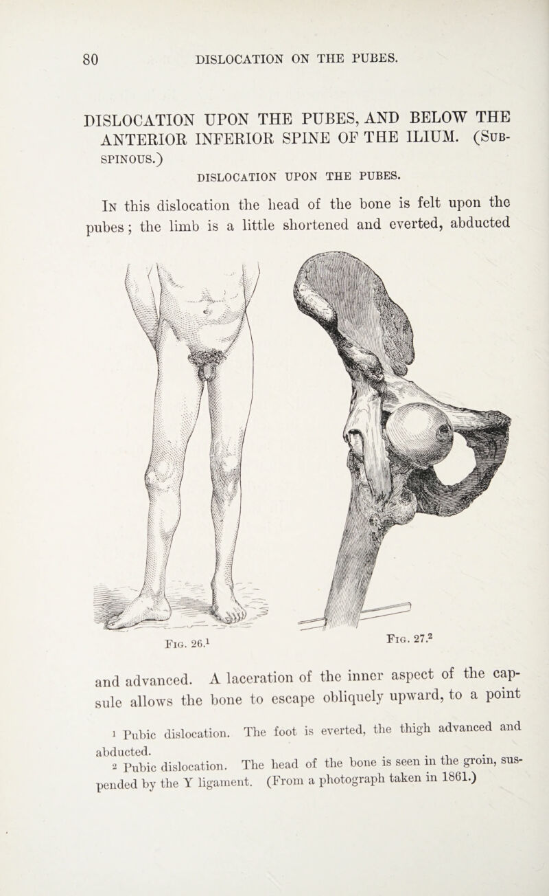 DISLOCATION UPON THE PUBES, AND BELOW THE ANTERIOR INFERIOR SPINE OF THE ILIUM. (Sub¬ spinous.) DISLOCATION UPON THE PUBES. In this dislocation the head of the bone is felt upon the pubes; the limb is a little shortened and everted, abducted Fig. 26.1 Fig. 27.2 and advanced. A laceration of the inner aspect of the cap¬ sule allows the bone to escape obliquely upward, to a point 1 Pubic dislocation. The foot is everted, the thigh advanced and abducted. . , 2 Pubic dislocation. The head of the bone is seen in the groin, sus¬ pended by the Y ligament. (From a photograph taken in 1861.)