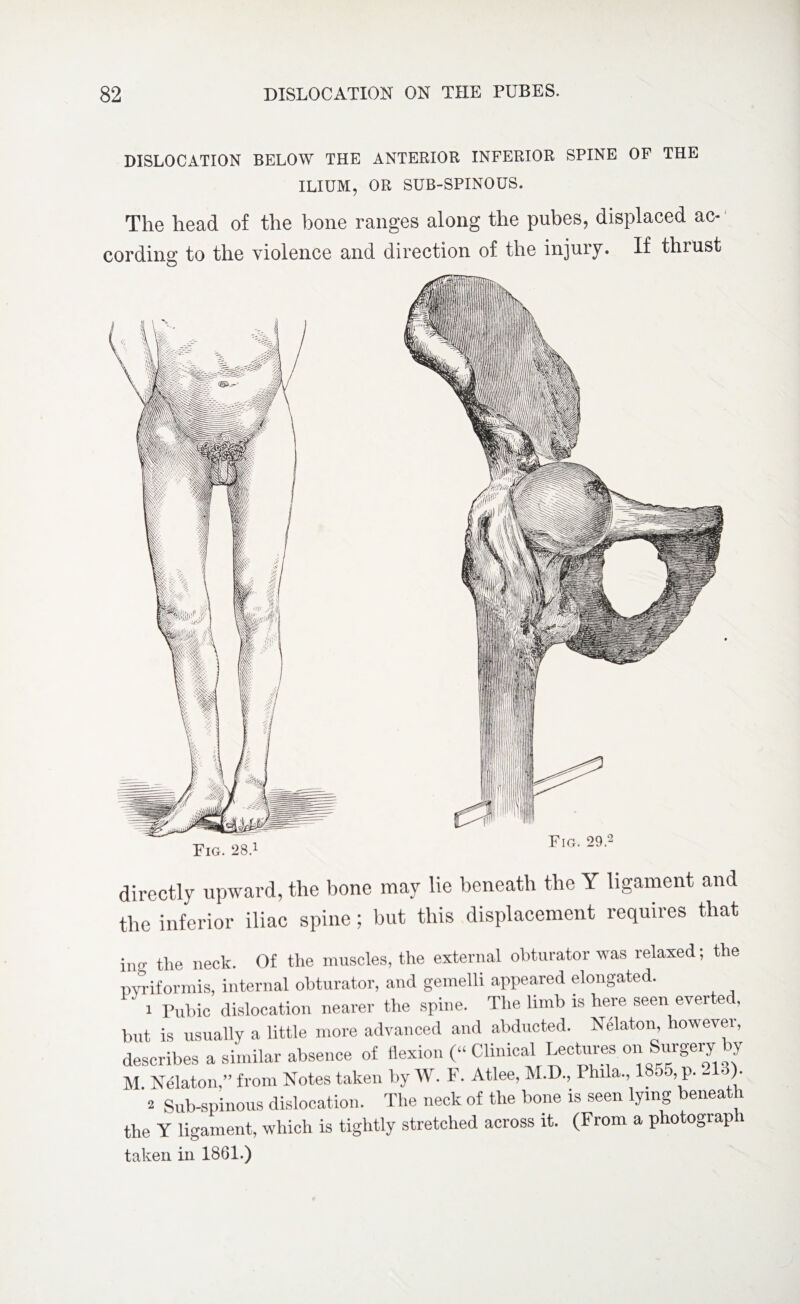 DISLOCATION BELOW THE ANTERIOR INFERIOR SPINE OF THE ILIUM, OR SUB-SPINOUS. The head of the bone ranges along the pubes, displaced ac¬ cording to the violence and direction of the injury. If thrust Fig. 29.2 directly upward, the bone may lie beneath the Y ligament and the inferior iliac spine; but this displacement requires that in,T tpe neck. Of the muscles, the external obturator was relaxed; the pvriformis, internal obturator, and gemelli appeared elongated. 1 Pubic dislocation nearer the spine. The limb is here seen everted, but is usually a little more advanced and abducted. Nelaton, however, describes a similar absence of flexion (“ Clinical Lectures on Surgery by M. Nelaton,” from Notes taken by W. F. Atlee, M.D., Phila., > >]?• - )• 2 Sub-spinous dislocation. The neck of the bone is seen lying beneath the Y ligament, which is tightly stretched across it. (From a photograp i