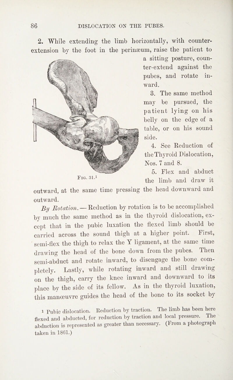 2. While extending the limb horizontally, with counter¬ extension by the foot in the perinaeum, raise the patient to a sitting posture, coun- ter-extend against the pubes, and rotate in¬ ward. 3. The same method may be pursued, the patient lying on his belly on the edge of a table, or on his sound side. 4. See Reduction of the Thyroid Dislocation, Nos. 7 and 8. 5. Flex and abduct the limb and draw it outward, at the same time pressing the head downward and outward. By Botation. — Reduction by rotation is to be accomplished by much the same method as in the thyroid dislocation, ex¬ cept that in the pubic luxation the flexed limb should be carried across the sound thigh at a highei point. Fust, semi-flex the thigh to relax the Y ligament, at the same time drawing the head of the bone down from the pubes. Then semi-abduct and rotate inward, to disengage the bone com¬ pletely. Lastly, while rotating inward and still drawing on the thigh, carry the knee inward and downward to its place by the side of its fellow. As in the thyroid luxation, this manoeuvre guides the head of the bone to its socket by i Pubic dislocation. Reduction by traction. The limb has been here flexed and abducted, for reduction by traction and local pressure. The abduction is represented as greater than necessary. (From a photograph taken in 1861.)