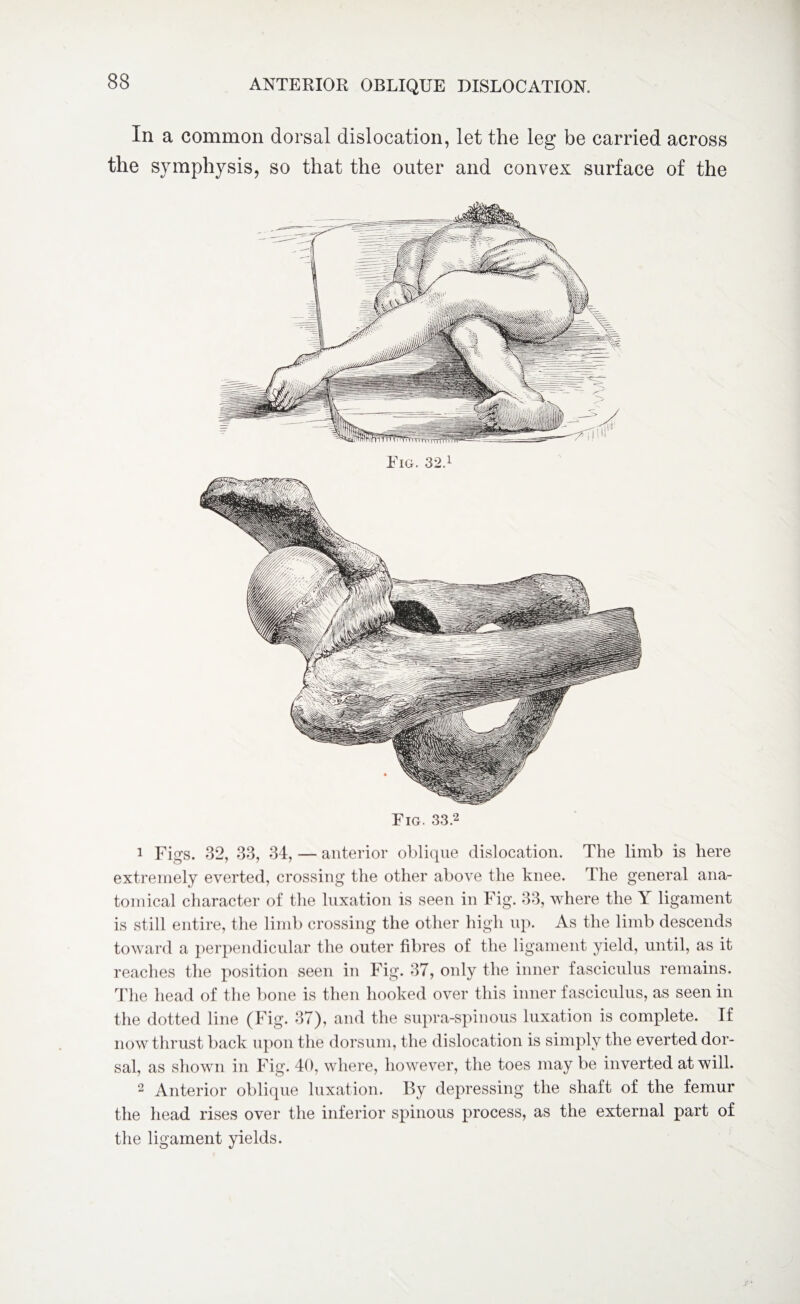 In a common dorsal dislocation, let the leg be carried across the symphysis, so that the outer and convex surface of the Fig. 33.2 1 Figs. 32, 33, 34, — anterior oblique dislocation. The limb is here extremely everted, crossing the other above the knee. The general ana¬ tomical character of the luxation is seen in Fig. 33, where the Y ligament is still entire, the limb crossing the other high up. As the limb descends toward a perpendicular the outer fibres of the ligament yield, until, as it reaches the position seen in Fig. 37, only the inner fasciculus remains. The head of the bone is then hooked over this inner fasciculus, as seen in the dotted line (Fig. 37), and the supra-spinous luxation is complete. If now thrust back upon the dorsum, the dislocation is simply the everted dor¬ sal, as shown in Fig. 40, where, however, the toes may be inverted at will. 2 Anterior oblique luxation. By depressing the shaft of the femur the head rises over the inferior spinous process, as the external part of the ligament yields.