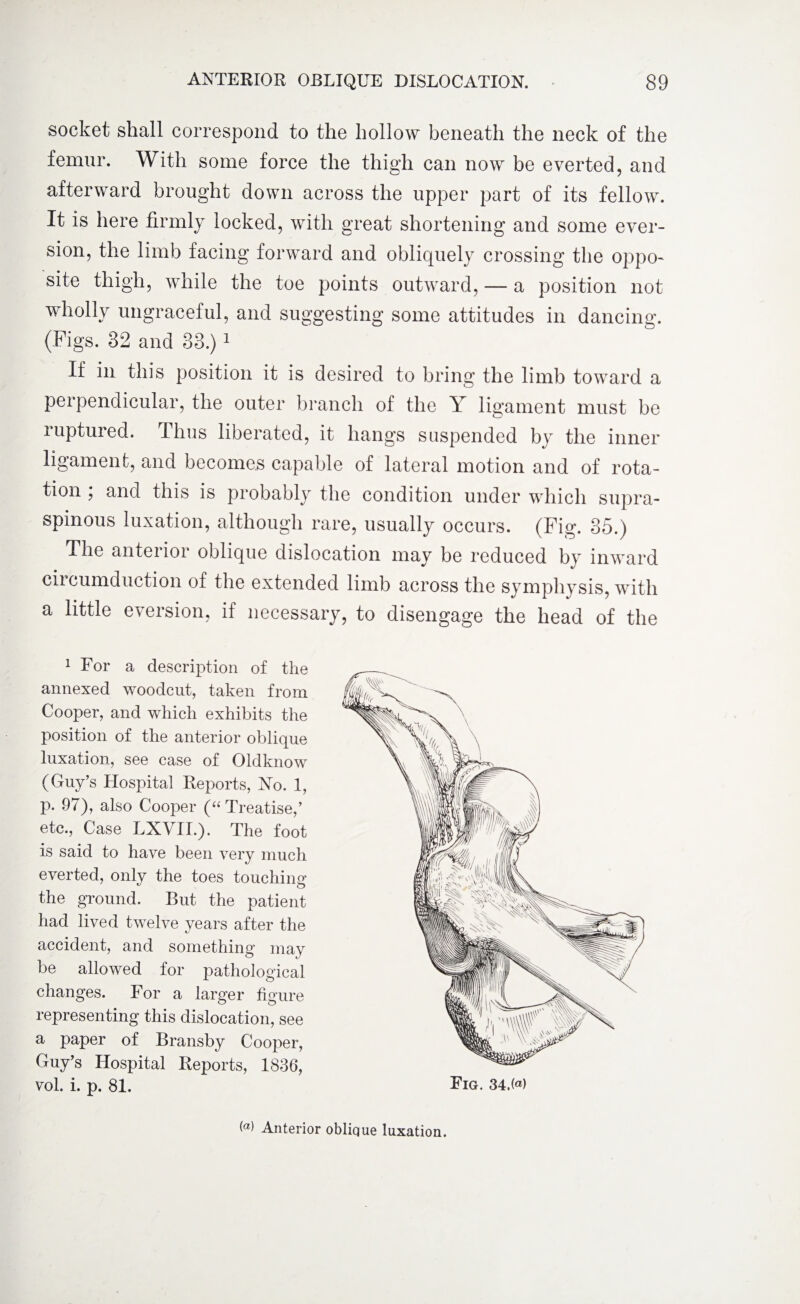 socket shall correspond to the hollow beneath the neck of the femur. With some force the thigh can now be everted, and afterward brought down across the upper part of its fellow. It is here firmly locked, with great shortening and some ever¬ sion, the limb facing forward and obliquely crossing the oppo¬ site thigh, while the toe points outward, — a position not wholly ungraceful, and suggesting some attitudes in dancing. (Figs. 32 and 33.)1 If in this position it is desired to bring the limb toward a perpendicular, the outer branch of the Y ligament must be ruptured. Thus liberated, it hangs suspended by the inner ligament, and becomes capable of lateral motion and of rota¬ tion , and this is probably the condition under which supra¬ spinous luxation, although rare, usually occurs. (Fig. 35.) The anteiioi oblique dislocation may be reduced by inward Ciicumduction of the extended limb across the symphysis, with a little eversion, if necessary, to disengage the head of the 1 For a description of the annexed woodcut, taken from Cooper, and which exhibits the position of the anterior oblique luxation, see case of Oldknow (Guy’s Hospital Reports, No. 1, p. 97), also Cooper (“ Treatise,’ etc., Case LXVIL). The foot is said to have been very much everted, only the toes touching the ground. But the patient had lived twelve years after the accident, and something may be allowed for pathological changes. For a larger figure representing this dislocation, see a paper of Bransby Cooper, Guy’s Hospital Reports, 1836, vol. i. p. 81. («) Anterior oblique luxation.