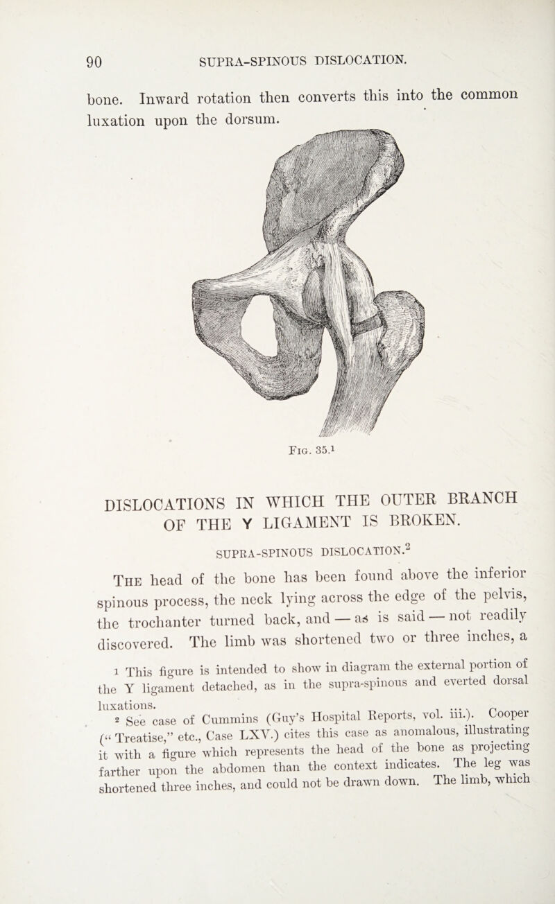 bone. Inward rotation then converts this into the common * luxation upon the dorsum. Fig. 35.1 DISLOCATIONS IN WHICH THE OUTER BRANCH OF THE Y LIGAMENT IS BROKEN. SUPRA-SPINOUS DISLOCATION.2 The head of the bone has been found above the inferior spinous process, the neck lying across the edge of the pelvis, the trochanter turned back, and — as is said not leadilv discovered. The limb was shortened two or three inches, a 1 This figure is intended to show in diagram the external portion of the Y ligament detached, as in the supraspinous and everted dorsal luxations. ... n 2 See case of Cummins (Guy’s Hospital Reports, vol. in.). Cooper (u Treatise,” etc., Case LXY.) cites this case as anomalous, illustrating it with a figure which represents the head of the hone as projecting farther upon the abdomen than the context indicates. The leg was shortened three inches, and could not be drawn down. The limb, whic l