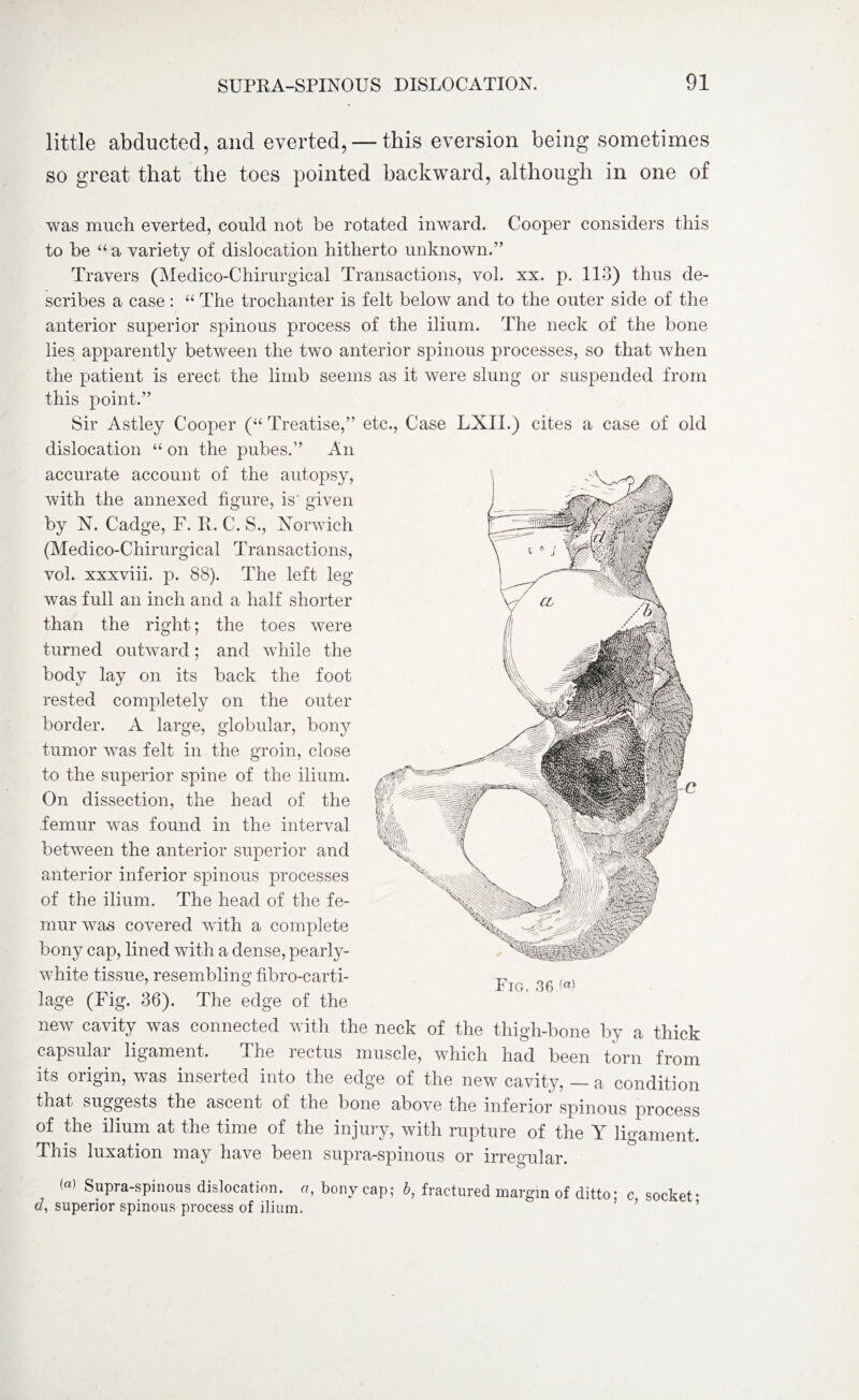 little abducted, and everted, — this eversion being sometimes so great that the toes pointed backward, although in one of was much everted, could not be rotated inward. Cooper considers this to be “a variety of dislocation hitherto unknown.” Travers (Medico-Chirurgical Transactions, vol. xx. p. 113) thus de¬ scribes a case : “ The trochanter is felt below and to the outer side of the anterior superior spinous process of the ilium. The neck of the bone lies apparently between the tvro anterior spinous processes, so that when the patient is erect the limb seems as it were slung or suspended from this point.” Sir Astley Cooper (“ Treatise,” etc., Case LXII.) cites a case of old dislocation “ on the pubes.” An accurate account of the autopsy, with the annexed figure, is' given by N. Cadge, F. R. C. S., Norwich (Medico-Chirurgical Transactions, vol. xxxviii. p. 88). The left leg was full an inch and a half shorter than the right; the toes were turned outward; and while the body lay on its back the foot rested completely on the outer border. A large, globular, bony tumor was felt in the groin, close to the superior spine of the ilium. On dissection, the head of the femur was found in the interval between the anterior superior and anterior inferior spinous processes of the ilium. The head of the fe¬ mur was covered with a complete bony cap, lined with a dense, pearly- white tissue, resembling fibro-carti- lage (Fig. 36). The edge of the new cavity was connected with the neck of the thigh-bone by a thick capsular ligament. The rectus muscle, which had been torn from its origin, was inserted into the edge of the new cavity, — a condition that suggests the ascent of the bone above the inferior spinous process of the ilium at the time of the injury, with rupture of the Y ligament. This luxation may have been supra-spinous or irregular. M Supra-spinous dislocation, a, bony cap; b, fractured margin of ditto- c socket- d, superior spinous process of ilium. Fig. 36.(«)