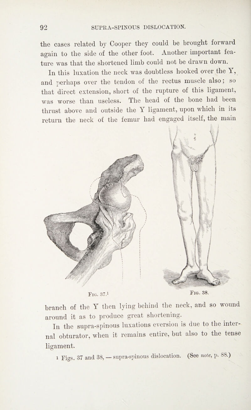 branch of the Y then lying behind the neck, and so wound around it as to produce great shortening. In the supra-spinous luxations eversion is due to the inter¬ nal obturator, when it remains entire, but also to the tense ligament. i Figs. 37 and 38, — supra-spinous the cases related by Cooper they could be brought forward again to the side of the other foot. Another important fea¬ ture was that the shortened limb could not be drawn down. In this luxation the neck was doubtless hooked over the Y, and perhaps over the tendon of the rectus muscle also; so that direct extension, short of the rupture of this ligament, was worse than useless. The head of the bone had been thrust above and outside the Y ligament, upon which in its return the neck of the femur had engaged itself, the main dislocation. (See note, p. 88.)