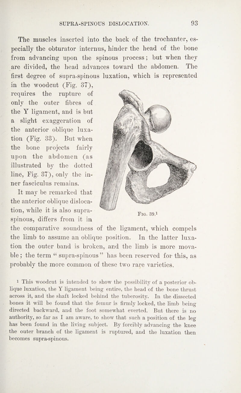 The muscles inserted into the back of the trochanter, es¬ pecially the obturator interims, hinder the head of the bone from advancing upon the spinous process; but when they are divided, the head advances toward the abdomen. The first degree of supra-spinous luxation, which is represented in the woodcut (Fig. 37), requires the rupture of only the outer fibres of the Y ligament, and is but a slight exaggeration of the anterior oblique luxa¬ tion (Fig. 33). But when the bone projects fairly upon the abdomen (as illustrated by the dotted line, Fig. 37), only the in¬ ner fasciculus remains. It may be remarked that the anterior oblique disloca¬ tion, while it is also supra¬ spinous, differs from it in the comparative soundness of the ligament, which compels the limb to assume an oblique position. In the latter luxa¬ tion the outer band is broken, and the limb is more mova¬ ble; the term “ supra-spinous” has been reserved for this, as probably the more common of these two rare varieties. 1 This woodcut is intended to show the possibility of a posterior ob¬ lique luxation, the Y ligament being entire, the head of the bone thrust across it, and the shaft locked behind the tuberosity. In the dissected bones it will be found that the femur is firmly locked, the limb being directed backward, and the foot somewhat everted. But there is no authority, so far as I am aware, to show that such a position of the leg has been found in the living subject. By forcibly advancing the knee the outer branch of the ligament is ruptured, and the luxation then becomes supra-spinous. Pig. 39.1