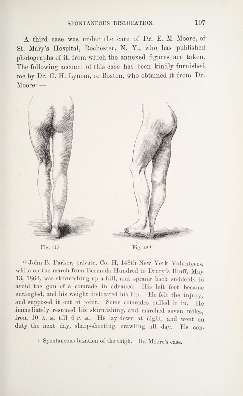 A third case was under the care of Dr. E. M. Moore, of St. Mary’s Hospital, Rochester, N. Y., who has published photographs of it, from which the annexed figures are taken. The following account of this case has been kindly furnished me by Dr. G. H. Lyman, of Boston, who obtained it from Dr. Moore: — “ John B. Parker, private, Co. PI, 148th Hew York Volunteers, while on the march from Bermuda Hundred to Drury’s Bluff, May 13, 1864, was skirmishing up a hill, and sprang back suddenly to avoid the gun of a comrade in advance. His left foot became entangled, and his weight dislocated his hip. He felt the injury, and supposed it out of joint. Some comrades pulled it in. He immediately resumed his skirmishing, and marched seven miles, from 10 A. m. till 6 p. m. He lay down at night, and went on duty the next day, sharp-shooting, crawling all day. He con- Fig. 42.1 Fig. 41.1 1 Spontaneous luxation of the thigh. Dr. Moore’s case.