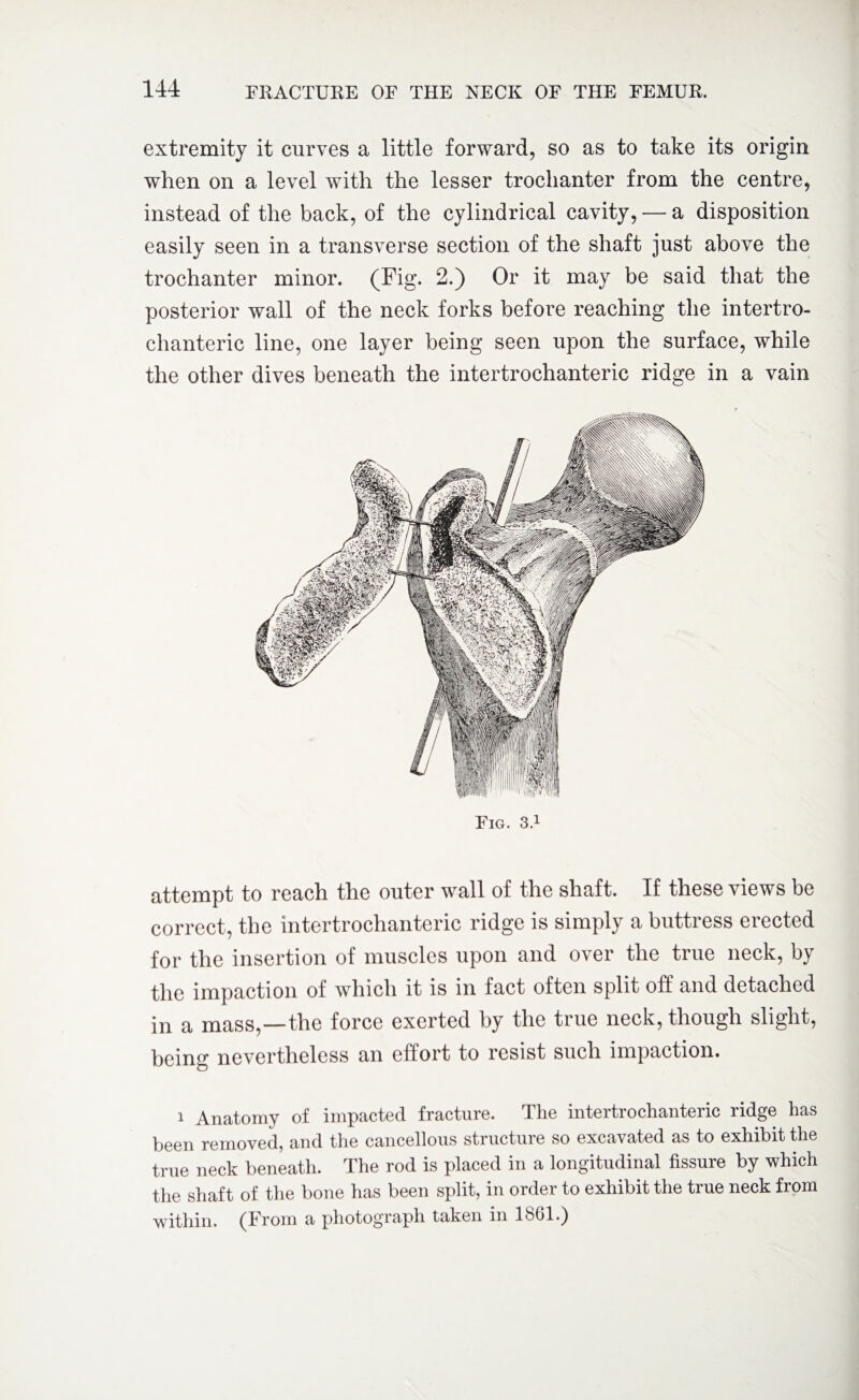 extremity it curves a little forward, so as to take its origin when on a level with the lesser trochanter from the centre, instead of the back, of the cylindrical cavity, — a disposition easily seen in a transverse section of the shaft just above the trochanter minor. (Fig. 2.) Or it may be said that the posterior wall of the neck forks before reaching the intertro¬ chanteric line, one layer being seen upon the surface, while the other dives beneath the intertrochanteric ridge in a vain Fig. 3.1 attempt to reach the outer wall of the shaft. If these views be correct, the intertrochanteric ridge is simply a buttress erected for the insertion of muscles upon and over the true neck, by the impaction of which it is in fact often split off and detached in a mass,—the force exerted by the true neck, though slight, being nevertheless an effort to resist such impaction. i Anatomy of impacted fracture. The intertrochanteric ridge has been removed, and the cancellous structure so excavated as to exhibit the true neck beneath. The rod is placed in a longitudinal fissure by which the shaft of the bone has been split, in order to exhibit the true neck from within. (From a photograph taken in 1861.)