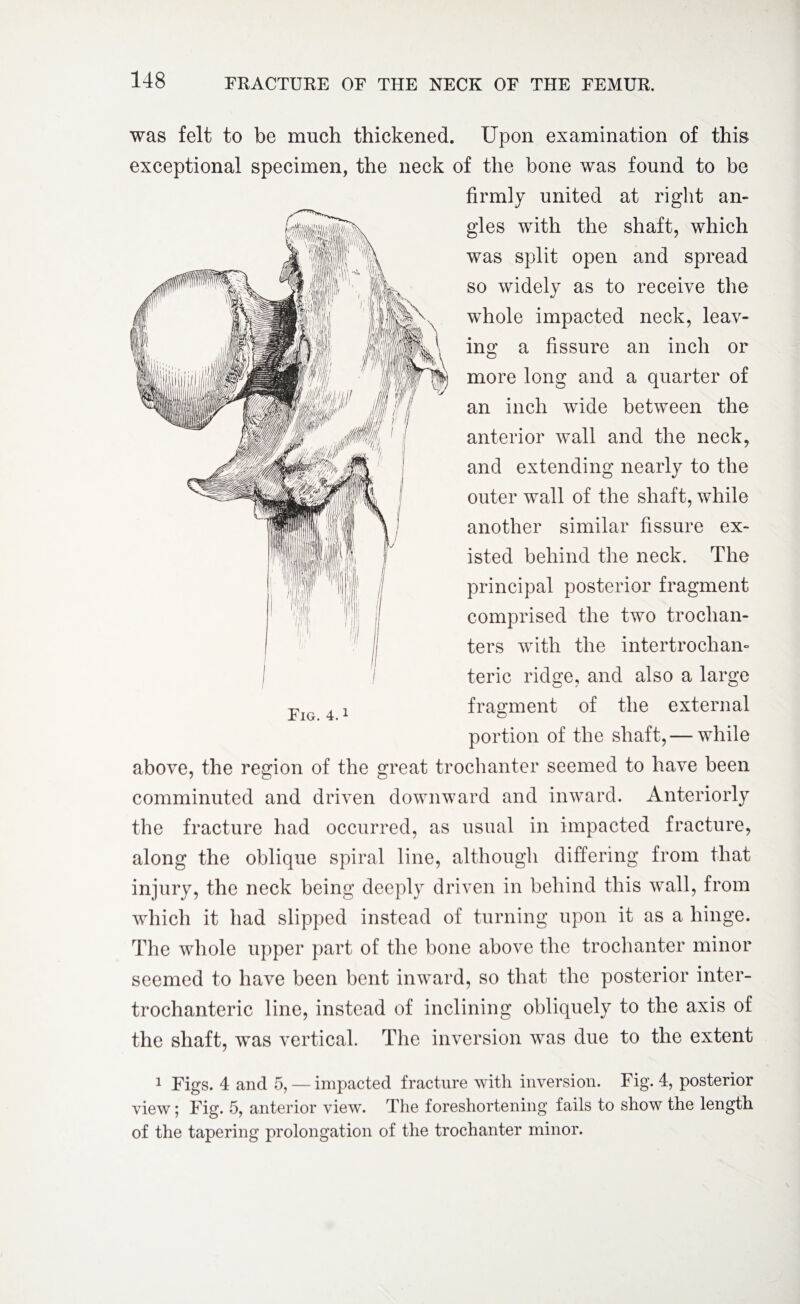 was felt to be much thickened. Upon examination of this exceptional specimen, the neck of the bone was found to be firmly united at right an¬ gles with the shaft, which was split open and spread so widely as to receive the whole impacted neck, leav¬ ing a fissure an inch or more long and a quarter of an inch wide between the anterior wall and the neck, and extending nearly to the outer wall of the shaft, while another similar fissure ex¬ isted behind the neck. The principal posterior fragment comprised the two trochan¬ ters with the intertrochan¬ teric ridge, and also a large fragment of the external portion of the shaft, — while above, the region of the great trochanter seemed to have been comminuted and driven downward and inward. Anteriorly the fracture had occurred, as usual in impacted fracture, along the oblique spiral line, although differing from that injury, the neck being deeply driven in behind this wall, from which it had slipped instead of turning upon it as a hinge. The whole upper part of the bone above the trochanter minor seemed to have been bent inward, so that the posterior inter¬ trochanteric line, instead of inclining obliquely to the axis of the shaft, was vertical. The inversion was due to the extent 1 Figs. 4 and 5, — impacted fracture with inversion. Fig. 4, posterior view; Fig. 5, anterior view. The foreshortening fails to show the length of the tapering prolongation of the trochanter minor.