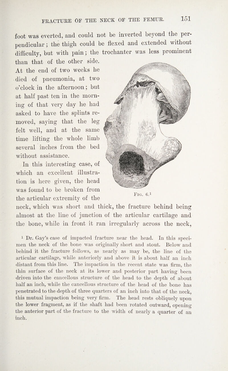 foot was everted, and could not be inverted beyond the per¬ pendicular ; the thigh could be flexed and extended without difficulty, but with pain; the trochanter was less prominent than that of the other side. At the end of two weeks he died of pneumonia, at two o’clock in the afternoon; but at half past ten in the morn¬ ing of that very day he had asked to have the splints re¬ moved, saying that the leg felt well, and at the same time lifting the whole limb several inches from the bed without assistance. In this interesting case, of which an excellent illustra¬ tion is here given, the head was found to be broken from the articular extremitv of the %/ neck, which was short and thick, the fracture behind being almost at the line of junction of the articular cartilage and the bone, while in front it ran irregularly across the neck, Fig. 6.1 1 Dr. Gay’s case of impacted fracture near the head. In this speci¬ men the neck of the bone was originally short and stout. Below and behind it the fracture follows, as nearly as may be, the line of the articular cartilage, while anteriorly and above it is about half an inch distant from this line. The impaction in the recent state was firm, the thin surface of the neck at its lower and posterior part having been driven into the cancellous structure of the head to the depth of about half an inch, while the cancellous structure of the head of the bone has penetrated to the depth of three quarters of an inch into that of the neck, this mutual impaction being very firm. The head rests obliquely upon the lower fragment, as if the shaft had been rotated outward, opening the anterior part of the fracture to the width of nearly a quarter of an inch.