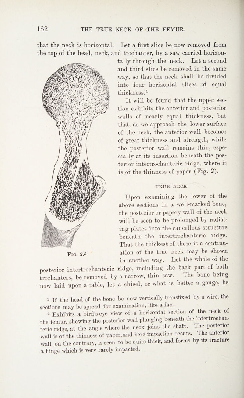 that the neck is horizontal. Let a first slice he now removed from the top of the head, neck, and trochanter, by a saw carried horizon¬ tally through the neck. Let a second and third slice be removed in the same way, so that the neck shall be divided into four horizontal slices of equal thickness.1 2 It will be found that the upper sec¬ tion exhibits the anterior and posterior walls of nearly equal thickness, but that, as wTe approach the lower surface of the neck, the anterior wall becomes of great thickness and strength, while the posterior wall remains thin, espe¬ cially at its insertion beneath the pos¬ terior intertrochanteric ridge, where it is of the thinness of paper (Fig. 2). TRUE NECK. Upon examining the lower of the above sections in a well-marked bone, the posterior or papery wall of the neck will be seen to be prolonged by radiat¬ ing plates into the cancellous structure beneath the intertrochanteric ridge. That the thickest of these is a continu¬ ation of the true neck may be shown in another way. Let the whole of the posterior intertrochanteric ridge, including the back part of both trochanters, be removed by a narrow, thin saw. The bone being now laid upon a table, let a chisel, or what is better a gouge, be 1 Tf the head of the bone be now vertically transfixed by a wire, the sections may be spread for examination, like a fan. 2 Exhibits a bird’s-eye view of a horizontal section of the neck o the femur, showing the posterior wall plunging beneath the intertrochan¬ teric ridge, at the angle where the neck joins the shaft. The posterior wall is of the thinness of paper, and here impaction occurs. The anterior wall, on the contrary, is seen to be quite thick, and forms by its fracture a hinge which is very rarely impacted.