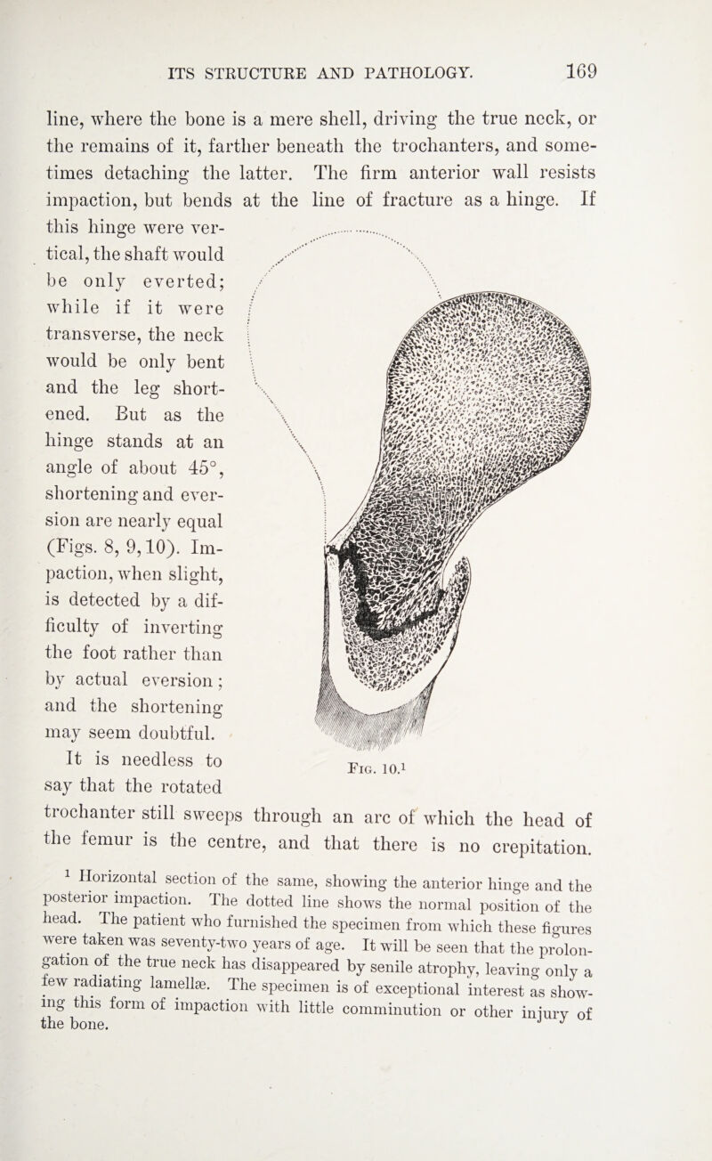 line, where the bone is a mere shell, driving the true neck, or the remains of it, farther beneath the trochanters, and some¬ times detaching the latter. The firm anterior wall resists impaction, but bends at the line of fracture as a hinge. If this hinge were ver- ..... tical, the shaft would be only everted; while if it were transverse, the neck would be onlv bent and the leg short¬ ened. But as the hinge stands at an angle of about 45°, shortening and ever¬ sion are nearly equal (Figs. 8, 9,10). Im¬ paction, when slight, is detected by a dif¬ ficulty of inverting the foot rather than by actual eversion; and the shortening may seem doubtful. It is needless to say that the rotated trochanter still sweeps through an arc of which the head of the femur is the centre, and that there is no crepitation. 1 Horizontal section of the same, showing the anterior hinge and the posterior impaction. The dotted line shows the normal position of the head. The patient who furnished the specimen from which these figures were taken was seventy-two years of age. It will be seen that the prolon¬ gation of the true neck has disappeared by senile atrophy, leaving only a few radiating lamellae. The specimen is of exceptional interest as show¬ ing this form of impaction with little comminution or other iniurv of the bone. J J