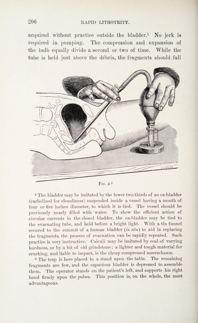 acquired without practice outside the bladder.1 2 No jerk is required in pumping. The compression and expansion of the bulb equally divide a second or two of time. While the tube is held just above the debris, the fragments should fall Fig. 4 2 1 The bladder may be imitated by the lower two-thirds of an ox-bladder (carbolized for cleanliness) suspended inside a vessel having a mouth of four or five inches diameter, to which it is tied. The vessel should be previously nearly filled with water. To show the efficient action of circular currents in the closed bladder, the ox-bladder may be tied to the evacuating tube, and held before a bright light. With a tin funnel secured to the summit of a human bladder (in situ) to aid in replacing the fragments, the process of evacuation can be rapidly repeated. Such practice is very instructive. Calculi may be imitated by coal of varying hardness, or by a bit of old grindstone; a lighter and tough material for crushing, and liable to impact, is the cheap compressed meerschaum. 2 The trap is here placed in a stand upon the table. The remaining fragments are few, and the capacious bladder is depressed to assemble them. The operator stands on the patient’s left, and supports his right hand firmly upon the pubes. This position is, on the whole, the most advantageous.