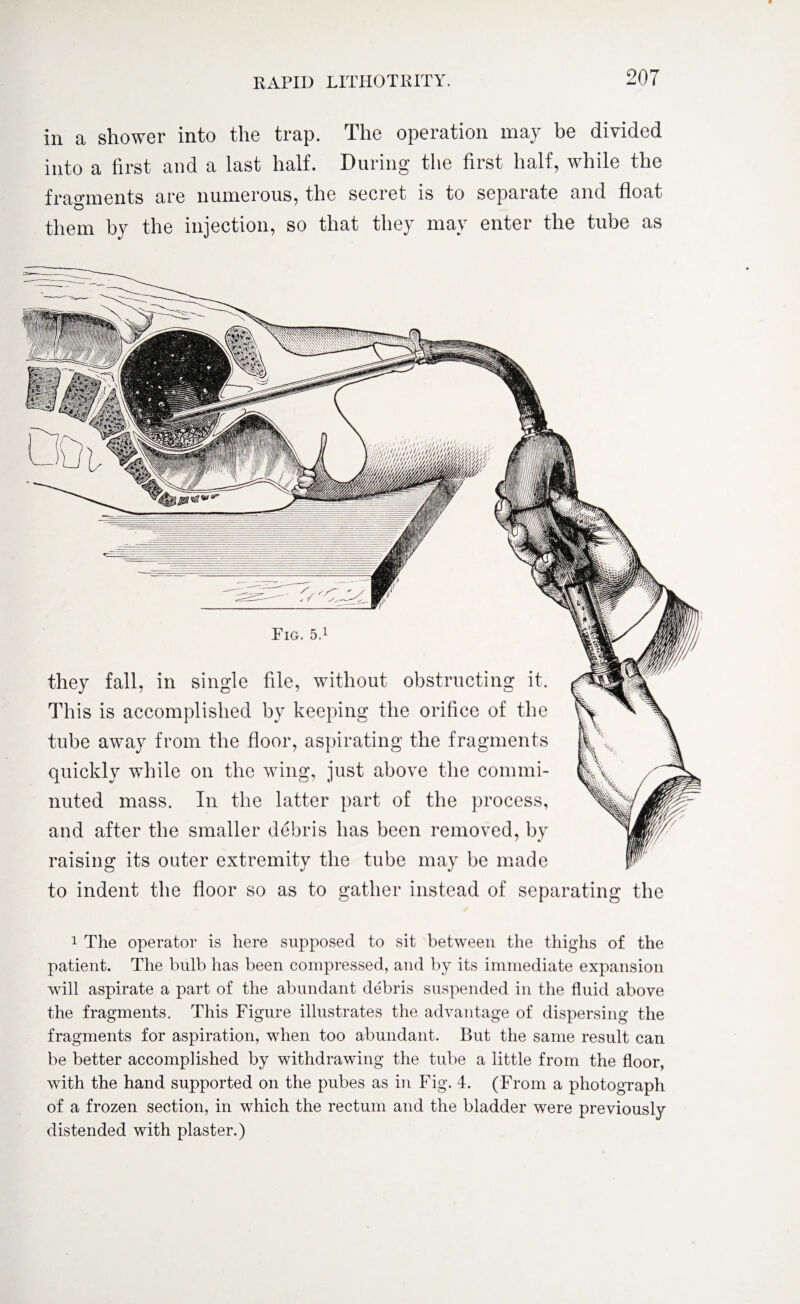 in a shower into the trap. The operation may be divided into a first and a last half. During the first half, while the fragments are numerous, the secret is to separate and float them by the injection, so that they may enter the tube as ^PPHS i - -n-s>vn^ ' \ msmi Fig. 5,1 they fall, in single file, without obstructing it. This is accomplished by keeping the orifice of the tube away from the floor, aspirating the fragments quickly while on the wing, just above the commi¬ nuted mass. In the latter part of the process, and after the smaller debris has been removed, by raising its outer extremity the tube may be made to indent the floor so as to gather instead of separating the 1 The operator is here supposed to sit between the thighs of the patient. The bulb has been compressed, and by its immediate expansion will aspirate a part of the abundant debris suspended in the fluid above the fragments. This Figure illustrates the advantage of dispersing the fragments for aspiration, when too abundant. But the same result can be better accomplished by withdrawing the tube a little from the floor, with the hand supported on the pubes as in Fig. 4. (From a photograph of a frozen section, in which the rectum and the bladder were previously distended with plaster.)