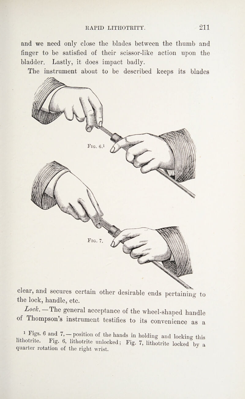 and we need only close the blades between the thumb and finger to be satisfied of their scissor-like action upon the bladder. Lastly, it does impact badly. The instrument about to be described keeps its blades X XU clear, and secures certain other desirable ends pertaining to the lock, handle, etc. Lock. The general acceptance of the wheel-shaped handle of Thompson’s instrument testifies to its convenience as a i Figs. 6 and 7,-position of the hands in holding and locking this lithotnte. Fig. 6, lithotrite unlocked; Fig. 7, lithotrite locked by a quarter rotation of the right wrist. J