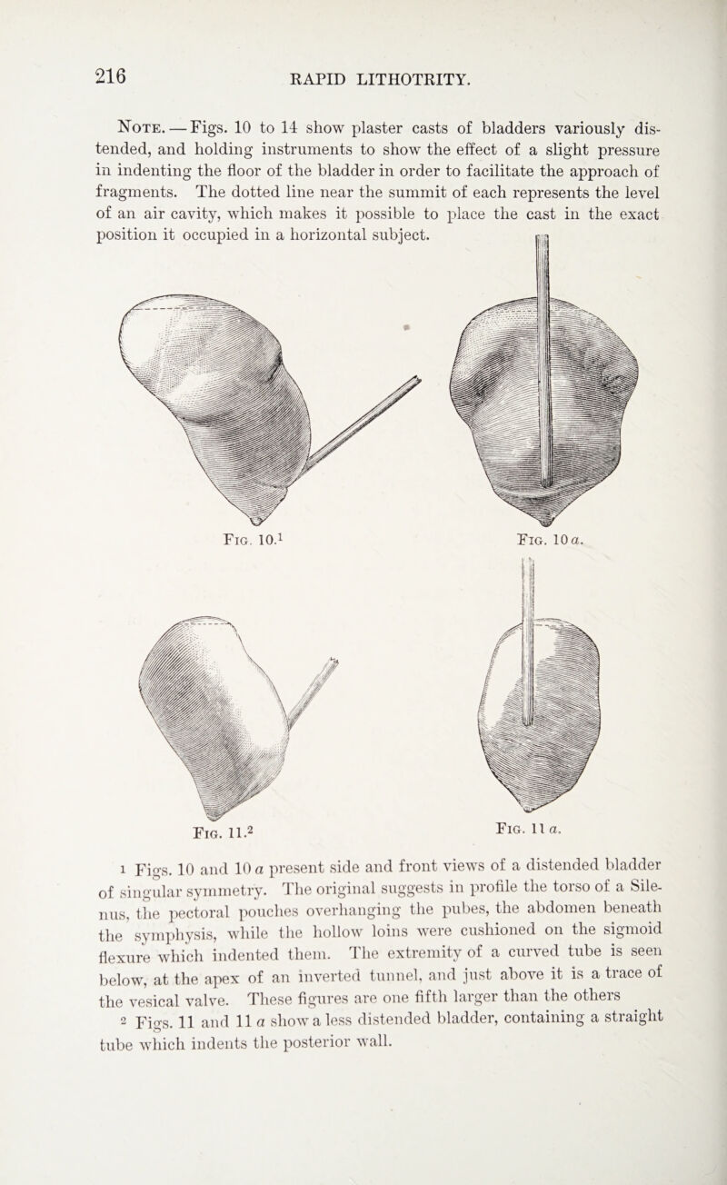 Note. — Figs. 10 to 14 show plaster casts of bladders variously dis¬ tended, and holding instruments to show the effect of a slight pressure in indenting the floor of the bladder in order to facilitate the approach of fragments. The dotted line near the summit of each represents the level of an air cavity, which makes it possible to place the cast in the exact position it occupied in a horizontal subject. m® Fig. 11.2 Fig. 11a. 1 Figs. 10 and 10 a present side and front views of a distended bladder of singular symmetry. The original suggests in profile the torso of a Sile- nus, the pectoral pouches overhanging the pubes, the abdomen beneath the symphysis, while the hollow loins were cushioned on the sigmoid flexure which indented them. The extremity of a curved tube is seen below, at the apex of an inverted tunnel, and just above it is a trace of the vesical valve. These figures are one fifth larger than the others 2 FI'ts. 11 and 11 a show a less distended bladder, containing a straight tube which indents the posterior wall.