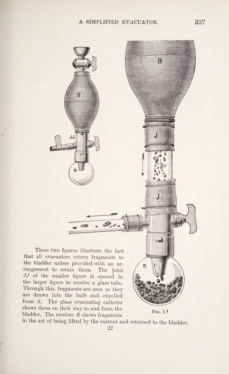 These two figures illustrate the fact that all evacuators return fragments to the bladder unless provided with an ar¬ rangement to retain them. The joint JJ of the smaller figure is opened in the larger figure to receive a glass tube. Through this, fragments are seen as they are drawn into the bulb and expelled from it. The glass evacuating catheter shows them on their way to and from the bladder. The receiver R shows fragments Fig. l.i in the act of being lifted by the current and returned to the bladder. 22 )