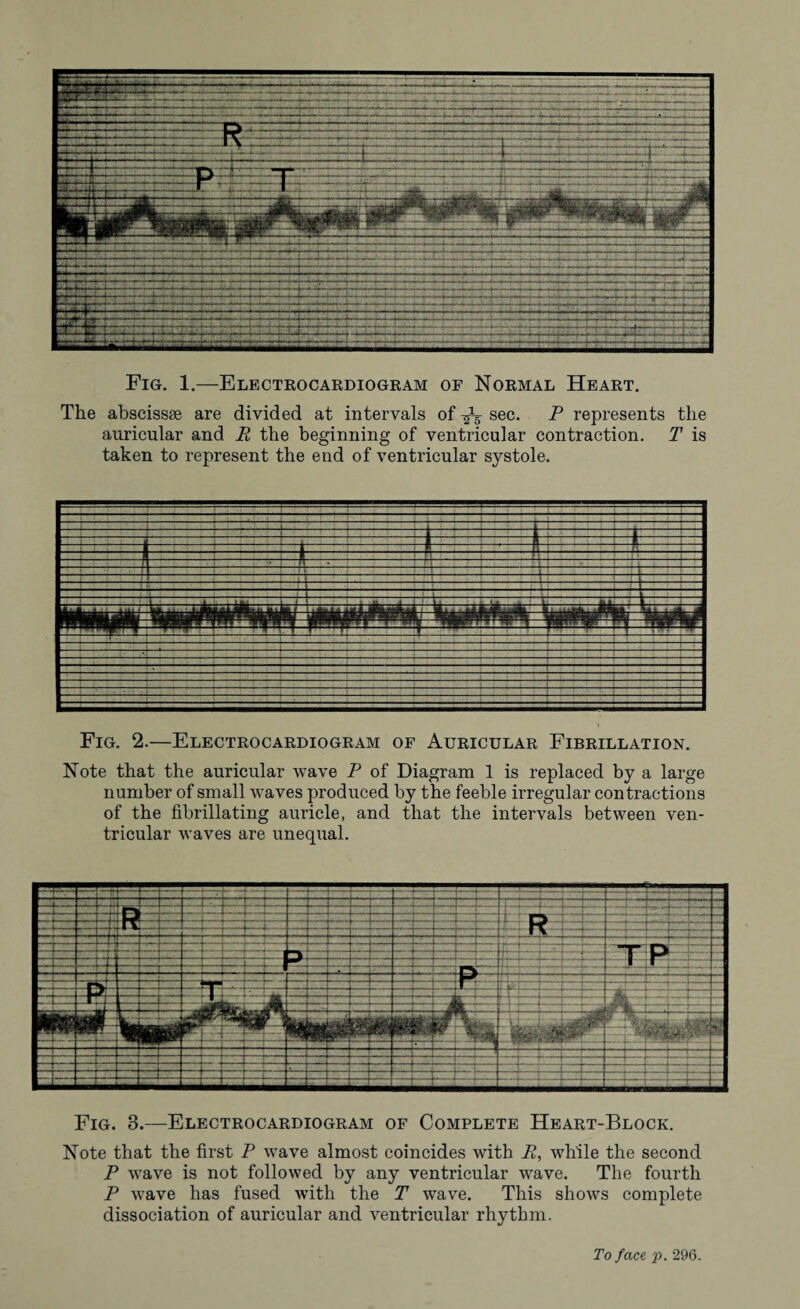 Fig. 1.—Electrocardiogram of Normal Heart. The abscissae are divided at intervals of ^ sec. P represents the auricular and R the beginning of ventricular contraction. T is taken to represent the end of ventricular systole. Fig, 2.—Electrocardiogram of Auricular Fibrillation. Note that the auricular wave P of Diagram 1 is replaced by a large number of small waves produced by the feeble irregular contractions of the fibrillating auricle, and that the intervals between ven¬ tricular waves are unequal. Fig. 3.—Electrocardiogram of Complete Heart-Block. Note that the first P wave almost coincides with R, while the second P wave is not followed by any ventricular wave. The fourth P wave has fused with the T wave. This shows complete dissociation of auricular and ventricular rhythm. To fact p. 296.