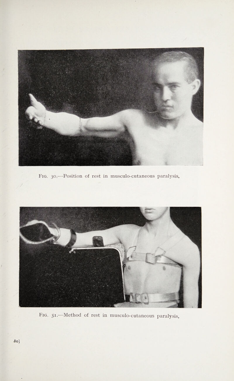 Fig. 30.-—-Position of rest in musculo-cutaneous paralysis Fig. 31.—Method of rest in musculo-cutaneous paralysis.