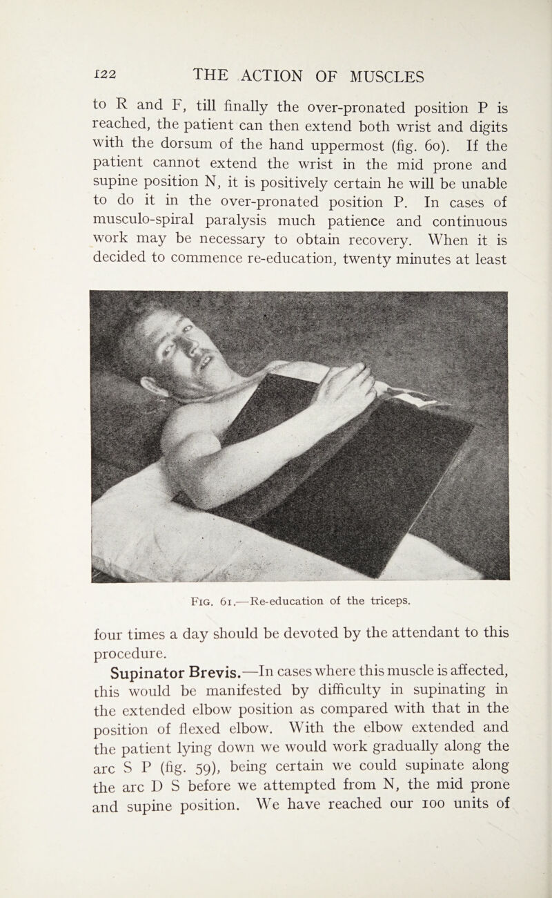 to R and F, till finally the over-pronated position P is reached, the patient can then extend both wrist and digits with the dorsum of the hand uppermost (fig. 60). If the patient cannot extend the wrist in the mid prone and supine position N, it is positively certain he will be unable to do it in the over-pronated position P. In cases of musculo-spiral paralysis much patience and continuous work may be necessary to obtain recovery. When it is decided to commence re-education, twenty minutes at least Fig. 6i.—Re-education of the triceps. four times a day should be devoted by the attendant to this procedure. Supinator Brevis.—In cases where this muscle is affected, this would be manifested by difficulty in supinating in the extended elbow position as compared with that in the position of flexed elbow. With the elbow extended and the patient lying down we would work gradually along the arc S P (fig. 59), being certain we could supinate along the arc D S before we attempted from N, the mid prone and supine position. We have reached our ioo units of