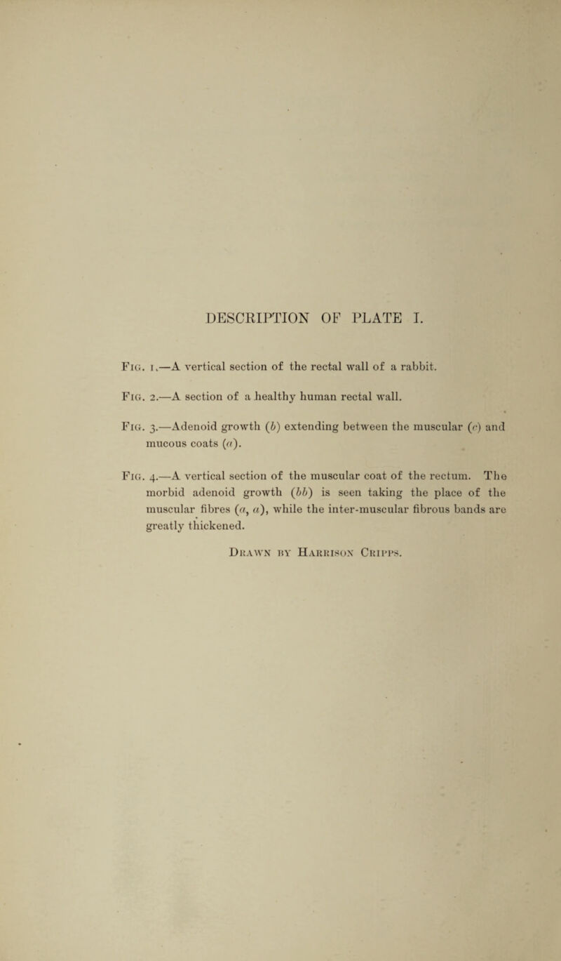 Fig. i.—A vertical section of the rectal wall of a rabbit. Fig. 2.—A section of a healthy human rectal wall. - ♦ Fig. 3.—Adenoid growth (b) extending between the muscular (c) and mucous coats («)• Fig. 4.—A vertical section of the muscular coat of the rectum. The morbid adenoid growth (bb) is seen taking the place of the muscular fibres (af a), while the inter-muscular fibrous bands are greatly thickened.