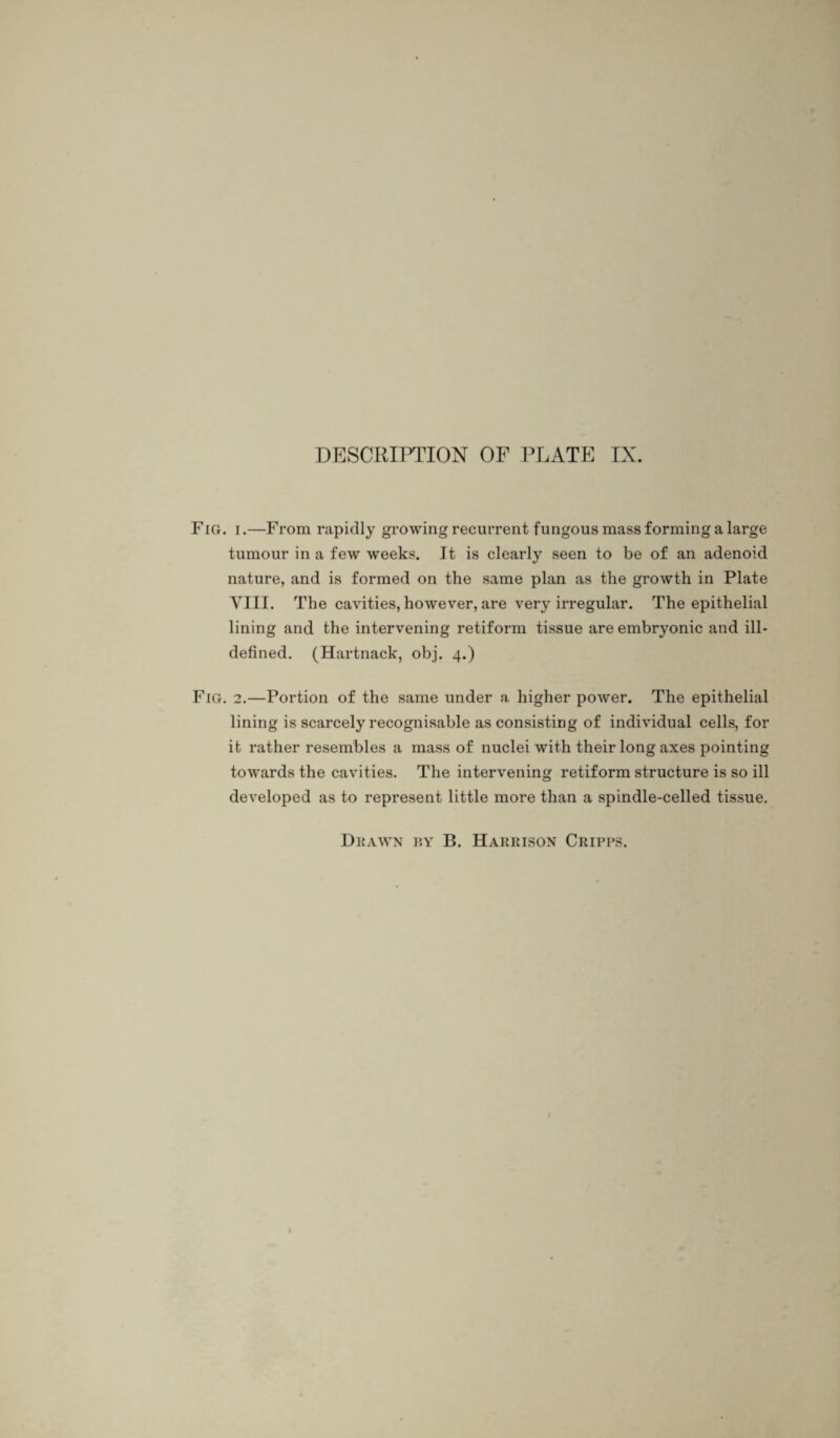 Fig. i.—From rapidly growing recurrent fungous mass forming a large tumour in a few weeks. It is clearly seen to be of an adenoid nature, and is formed on the same plan as the growth in Plate VIII. The cavities, however, are very irregular. The epithelial lining and the intervening retiform tissue are embryonic and ill- defined. (Hartnack, obj. 4.) Fig. 2.—Portion of the same under a higher power. The epithelial lining is scarcely recognisable as consisting of individual cells, for it rather resembles a mass of nuclei with their long axes pointing towards the cavities. The intervening retiform structure is so ill developed as to represent little more than a spindle-celled tissue.