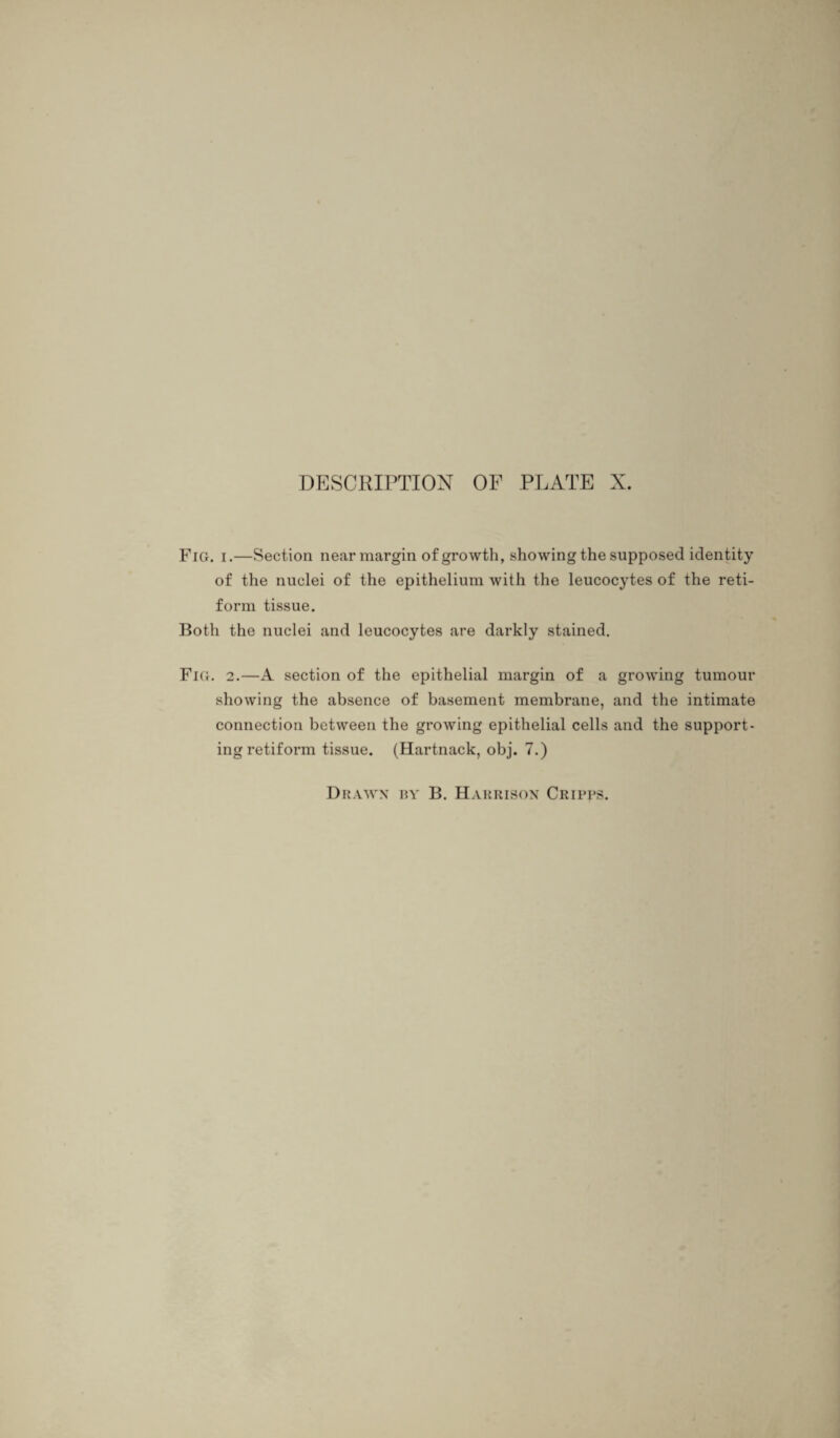 Fig. i.—Section near margin of growth, showing the supposed identity of the nuclei of the epithelium with the leucocytes of the reti- form tissue. Both the nuclei and leucocytes are darkly stained. Fig. 2.—A section of the epithelial margin of a growing tumour showing the absence of basement membrane, and the intimate connection between the growing epithelial cells and the support¬ ing retiform tissue. (Hartnack, obj. 7.)