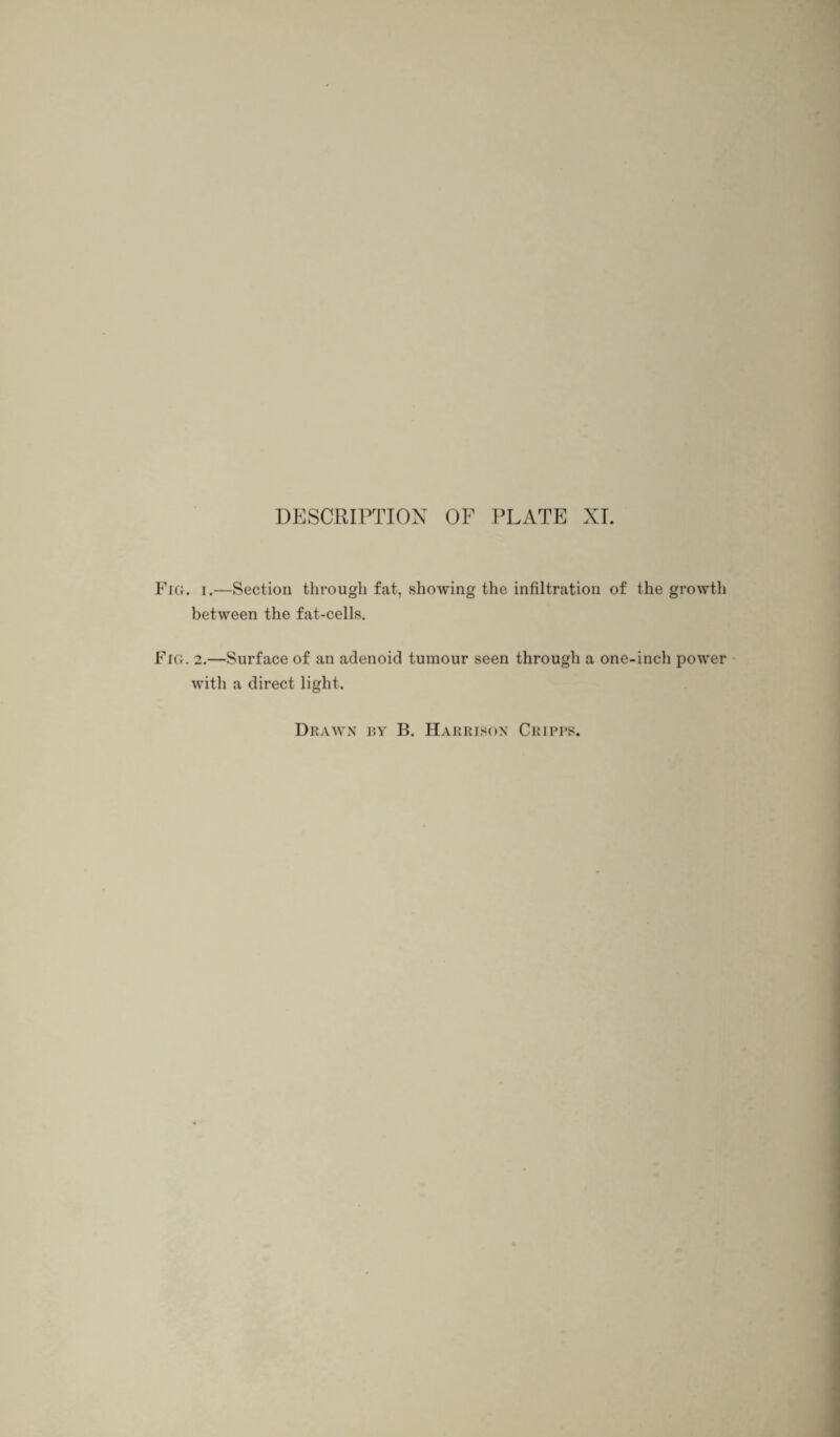 Fi(r. i.—Section through fat, showing the infiltration of the growth between the fat-cells. Fra. 2.—Surface of an adenoid tumour seen through a one-inch power with a direct light.
