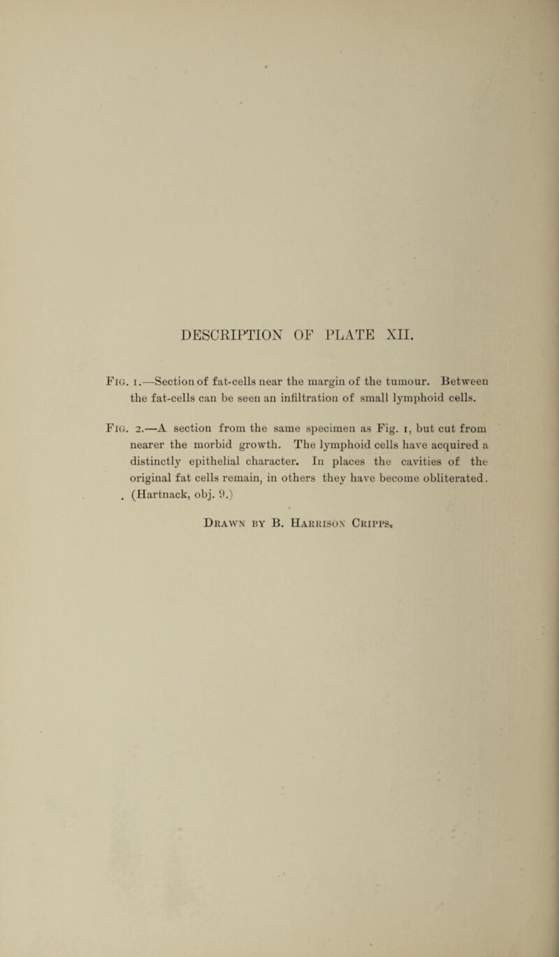 Fig. i.—Section of fat-cells near the margin of the tumour. Between the fat-cells can be seen an infiltration of small lymphoid cells. Fig. 2.—A section from the same specimen as Fig. i, but cut from nearer the morbid growth. The lymphoid cells have acquired a distinctly epithelial character. In places the cavities of the original fat cells remain, in others they have become obliterated. . (Hartnack, obj. 9.)