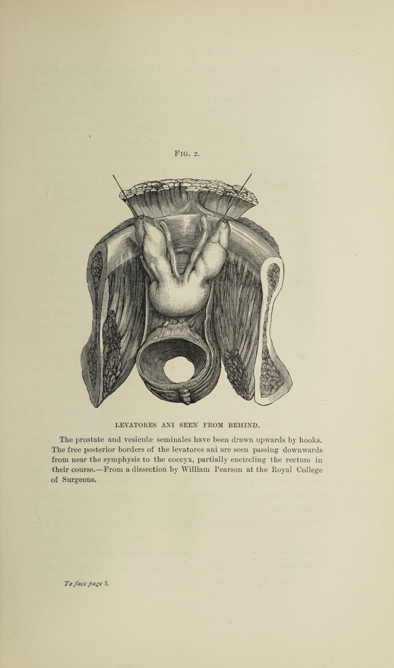 Fig. 2. LEYATOItES AXI SEEN FROM BEHIND. The prostate and vesiculse seminales have been drawn upwards by hooks. The free posterior borders of the levatores ani are seen passing downwards from near the symphysis to the coccyx, partially encircling the rectum in their course.—From a dissection by William Pearson at the Royal College of Surgeons.
