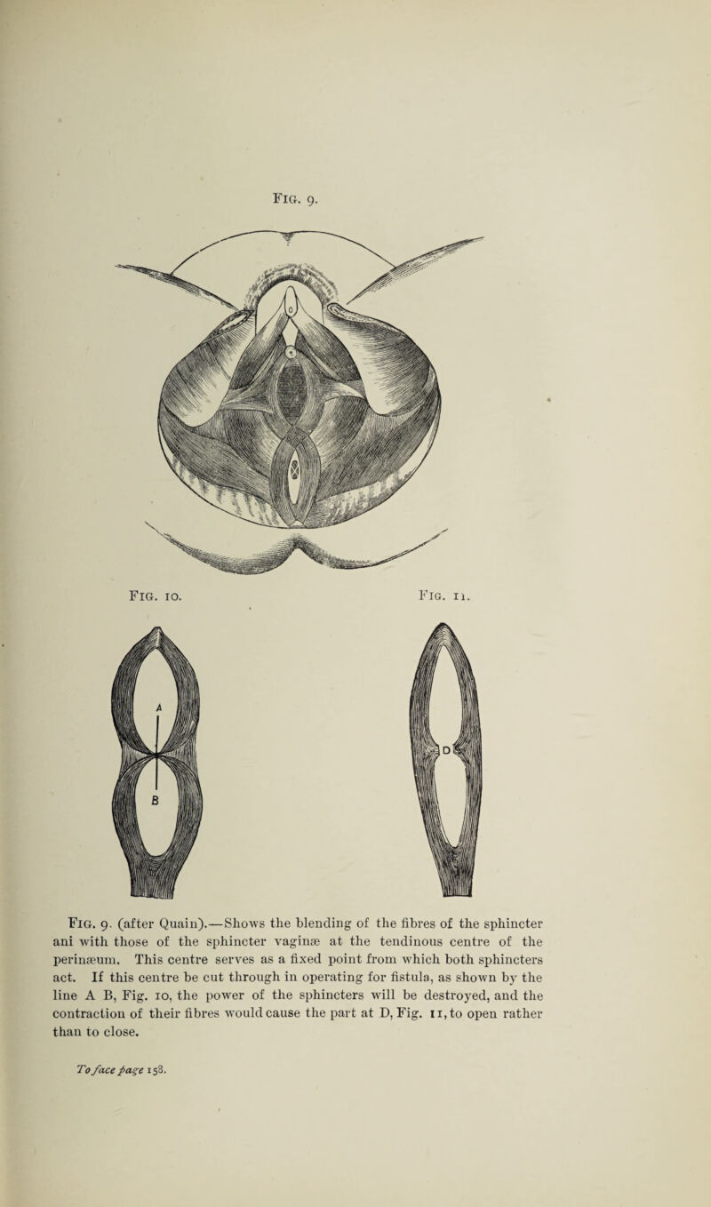 Fig. 10. Fig. ii. Fig. 9. (after Quain).—Shows the blending of the fibres of the sphincter ani with those of the sphincter vaginas at the tendinous centre of the perinaeum. This centre serves as a fixed point from which both sphincters act. If this centre be cut through in operating for fistula, as shown by the line A B, Fig. 10, the power of the sphincters will be destroyed, and the contraction of their fibres would cause the part at D, Fig. n,to open rather than to close.