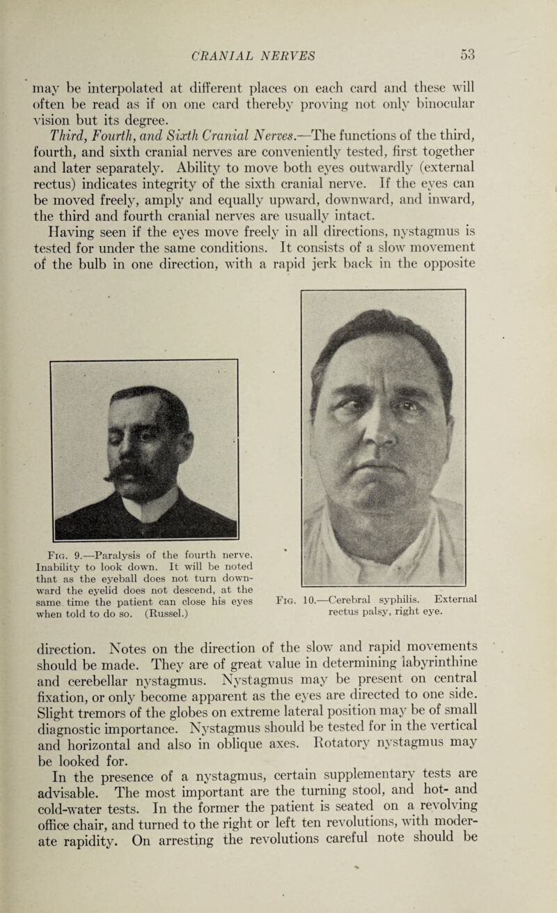 may be interpolated at different places on each card and these will often be read as if on one card thereby proving not only binocular vision but its degree. Third, Fourth, and Sixth Cranial Nerves.—'The functions of the third, fourth, and sixth cranial nerves are conveniently tested, first together and later separately. Ability to move both eyes outwardly (external rectus) indicates integrity of the sixth cranial nerve. If the eyes can be moved freely, amply and equally upward, downward, and inward, the third and fourth cranial nerves are usually intact. Having seen if the eyes move freely in all directions, nystagmus is tested for under the same conditions. It consists of a slow movement of the bulb in one direction, with a rapid jerk back in the opposite Fig. 9.—Paralysis of the fourth nerve. Inability to look down. It will be noted that as the eyeball does not turn down¬ ward the eyelid does not descend, at the same, time the patient can close his eyes Fig. 10. Cerebral syphilis. External when told to do so. (Russel.) rectus palsy, right eye. direction. Notes on the direction of the slow and rapid movements should be made. They are of great value in determining labyrinthine and cerebellar nystagmus. Nystagmus may be present on central fixation, or only become apparent as the eyes are directed to one side. Slight tremors of the globes on extreme lateral position may be of small diagnostic importance. Nystagmus should be tested for in the vertical and horizontal and also in oblique axes. Rotatory nystagmus may be looked for. In the presence of a nystagmus, certain supplementary tests are advisable. The most important are the turning stool, and hot- and cold-water tests. In the former the patient is seated on a revol\ ing office chair, and turned to the right or left ten revolutions, with moder¬ ate rapidity. On arresting the revolutions careful note should be