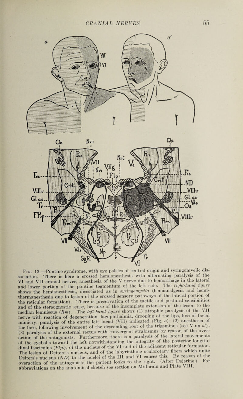 Fig. 12.—Pontine syndrome, with eye palsies of central origin and syringomyelic dis¬ sociation. There is here a crossed hemianesthesia with alternating paralysis of the VI and VII cranial nerves, anesthesia of the V nerve due to hemorrhage in the lateral and lower portion of the pontine tegmentum of the left side. The right-hand figure shows the hemianesthesia, dissociated as in syringomyelia (hemianalgesia and hemi- thermanesthesia due to lesion of the crossed sensory pathways of the lateral portion of the reticular formation). There is preservation of the tactile and postural sensibilities and of the stereognostic sense, because of the incomplete extension of the lesion to the median lemniscus (Rm). The left-hand figure shows (1) atrophic paralysis of the VII nerve with reaction of degeneration, lagophthalmia, drooping of the lips, loss of facial mimicry, paralysis of the entire left facial (VII) indicated (Fig. a), (2) anesthesia of the face, following involvement of the descending root of the trigeminus (see V on a ), (3) paralysis of the external rectus with convergent strabismus by reason of the over¬ action of the antagonists. Furthermore, there is a paralysis of the lateial movements of the eyeballs toward the left notwithstanding the integrity of the posterior longitu¬ dinal fasciculus (Flp.), of the nucleus of the VI and of the adjacent reticular formation. The lesion of Deiters’s nucleus, and of the labyrinthine oculorotary fibers which unite Deiters’s nucleus (ND) to the nuclei of the III and VI causes this. By reason of the overaction of the antagonists the patient looks to the right. (After Dejerine.) lor abbreviations on the anatomical sketch see section on Midbrain and late