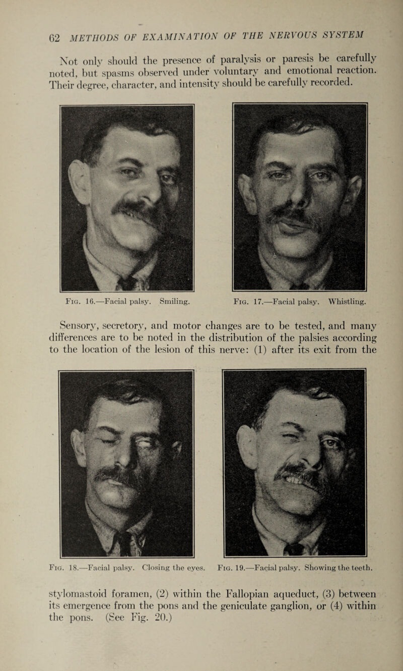 Fig. 18.—Facial palsy. Closing the eyes. Fig. 19.—Facial palsy. Showing the teeth. Not only should the presence of paralysis or paresis be carefully noted, but spasms observed under voluntary and emotional reaction. Their degree, character, and intensity should be carefully recorded. Fig. 16.—Facial palsy. Smiling. Fig. 17.—Facial palsy. Whistling. Sensory, secretory, and motor changes are to be tested, and many differences are to be noted in the distribution of the palsies according to the location of the lesion of this nerve: (1) after its exit from the at stylomastoid foramen, (2) within the Fallopian aqueduct, (3) between its emergence from the pons and the geniculate ganglion, or (4) within the pons. (See Fig. 20.)