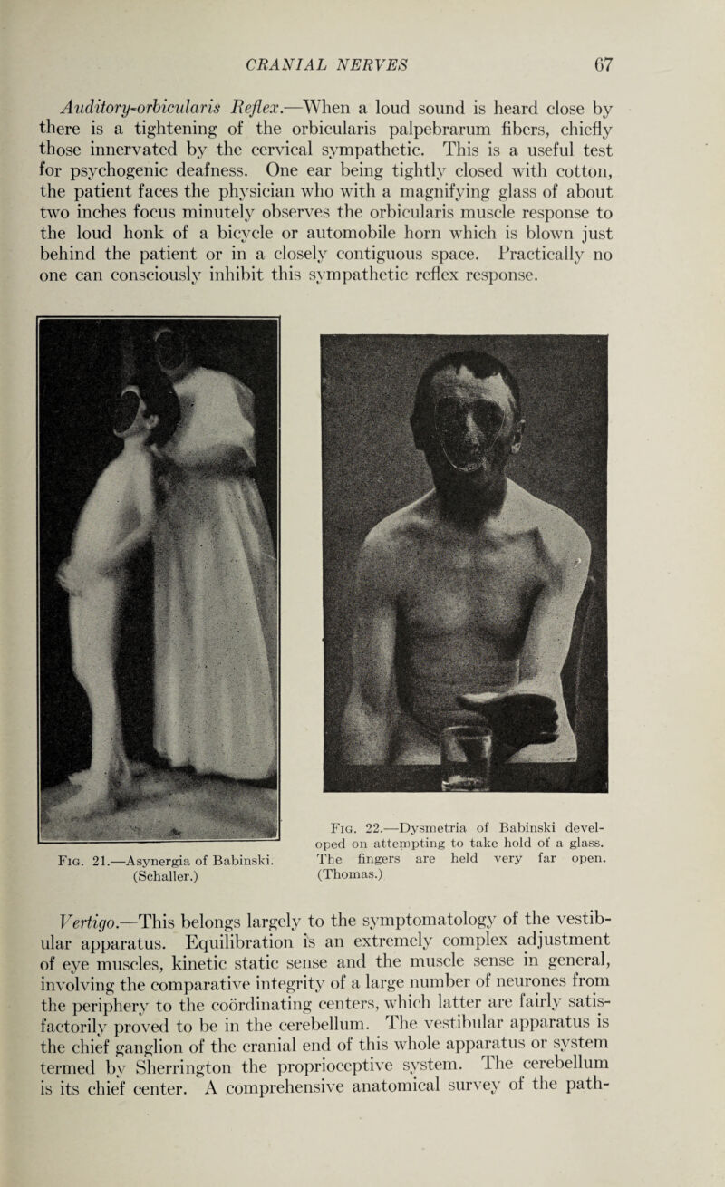 Auditory-orbicularis Reflex.—When a loud sound is heard close by there is a tightening of the orbicularis palpebrarum fibers, chiefly those innervated by the cervical sympathetic. This is a useful test for psychogenic deafness. One ear being tightly closed with cotton, the patient faces the physician who with a magnifying glass of about two inches focus minutely observes the orbicularis muscle response to the loud honk of a bicycle or automobile horn which is blown just behind the patient or in a closely contiguous space. Practically no one can consciously inhibit this sympathetic reflex response. Vertigo.—1This belongs largely to the symptomatology of the vestib¬ ular apparatus. Equilibration is an extremely complex adjustment of eye muscles, kinetic static sense and the muscle sense in general, involving the comparative integrity of a large number of neurones from the periphery to the coordinating centers, which latter are fairly satis¬ factorily proved to be in the cerebellum. 1 he vestibular apparatus is the chief ganglion of the cranial end of this whole apparatus or system termed by Sherrington the proprioceptive system, the cerebellum is its chief center. A .comprehensive anatomical survey of the path- Fig. 21.—Asynergia of Babinski. (Schaller.) Fig. 22.—Dysinetria. of Babinski devel¬ oped on attempting to take hold of a glass. The fingers are held very far open. (Thomas.)