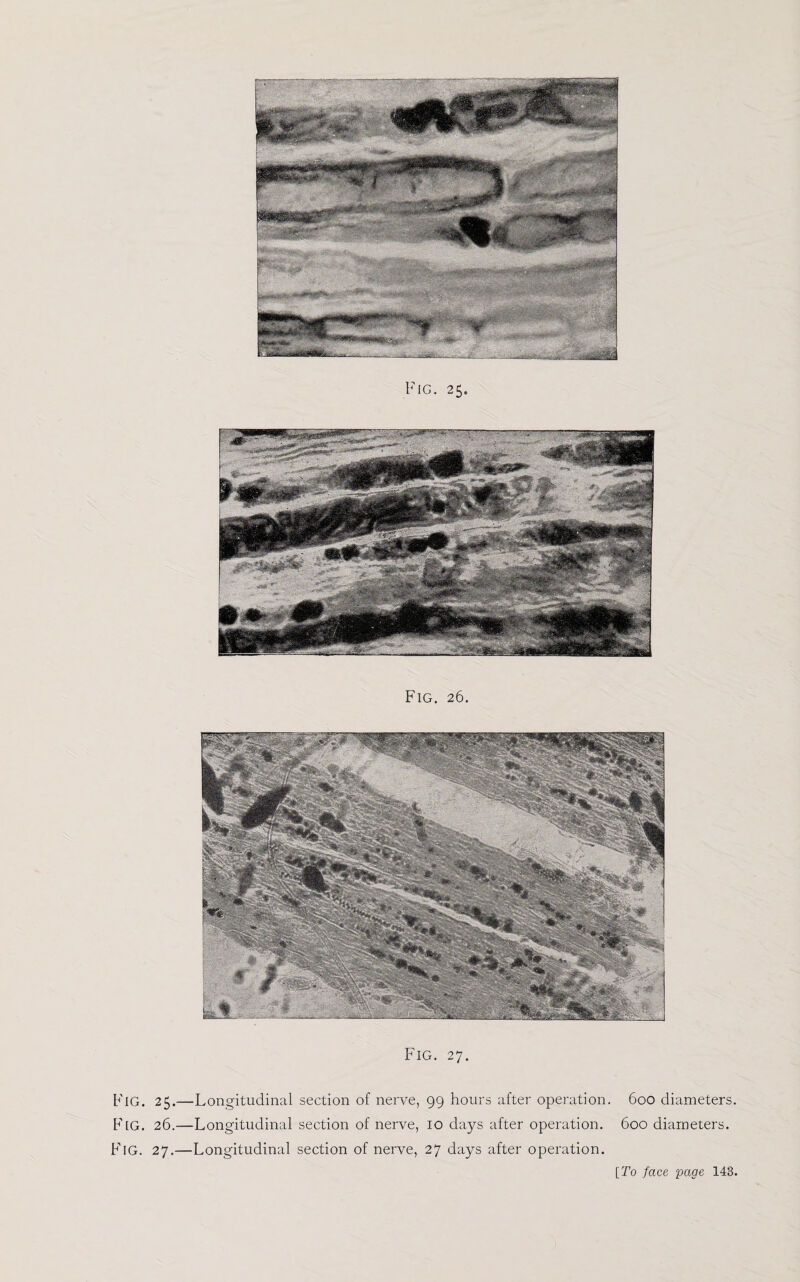 Fig. 26. Fig. 27. FlG. 25.—Longitudinal section of nerve, 99 hours after operation. 600 diameters. Fig. 26.—Longitudinal section of nerve, 10 days after operation. 600 diameters. FlG. 27.—Longitudinal section of nerve, 27 days after operation.