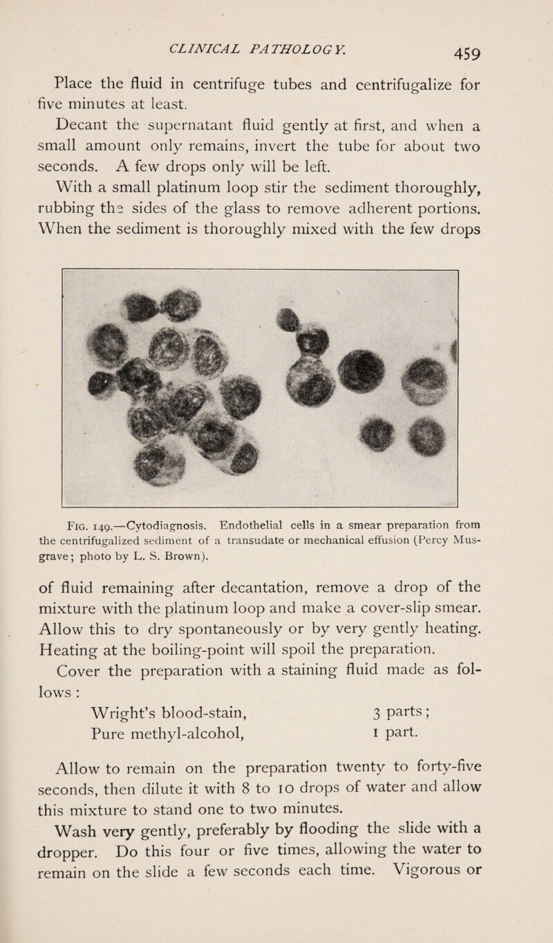 Place the fluid in centrifuge tubes and centrifugalize for five minutes at least. Decant the supernatant fluid gently at first, and when a small amount only remains, invert the tube for about two seconds. A few drops only will be left. With a small platinum loop stir the sediment thoroughly, rubbing the sides of the glass to remove adherent portions. When the sediment is thoroughly mixed with the few drops Fig. 149.—Cytodiagnosis. Endothelial cells in a smear preparation from the centrifugalized sediment of a transudate or mechanical effusion (Percy Mus- grave; photo by L. S. Brown). of fluid remaining after decantation, remove a drop of the mixture with the platinum loop and make a cover-slip smear. Allow this to dry spontaneously or by very gently heating. Heating at the boiling-point will spoil the preparation. Cover the preparation with a staining fluid made as fol¬ lows : Wright’s blood-stain, 3 Par^s 5 Pure methyl-alcohol, I part. Allow to remain on the preparation twenty to forty-five seconds, then dilute it with 8 to 10 drops of water and allow this mixture to stand one to two minutes. Wash very gently, preferably by flooding the slide with a dropper. Do this four or five times, allowing the water to remain on the slide a few seconds each time. Vigorous or