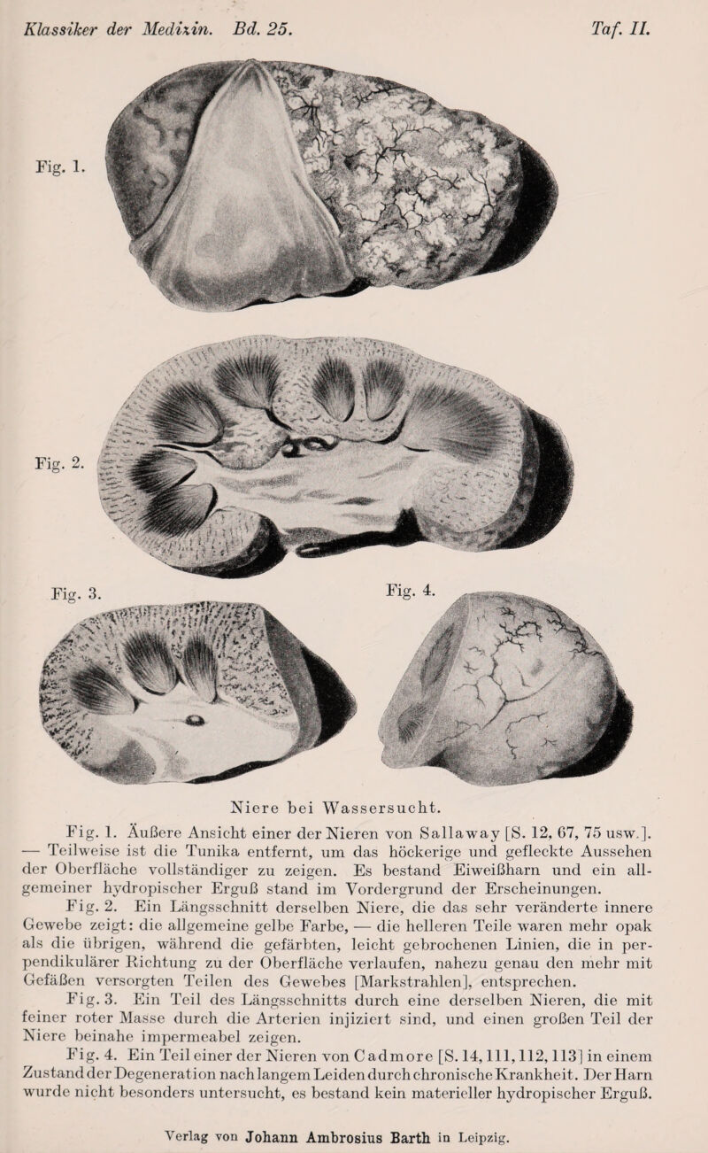 Fig. 1. Niere bei Wassersucht. Fig. 1. Äußere Ansicht einer cler Nieren von Sallaway [S. 12, 67, 75 usw,]. — Teilweise ist die Tunika entfernt, um das höckerige und gefleckte Aussehen der Oberfläche vollständiger zu zeigen. Es bestand Eiweißharn und ein all¬ gemeiner hydropischer Erguß stand im Vordergrund der Erscheinungen. Fig. 2. Ein Längsschnitt derselben Niere, die das sehr veränderte innere Gewebe zeigt: die allgemeine gelbe Farbe, — die helleren Teile waren mehr opak als die übrigen, während die gefärbten, leicht gebrochenen Linien, die in per¬ pendikulärer Richtung zu der Oberfläche verlaufen, nahezu genau den mehr mit Gefäßen versorgten Teilen des Gewebes [Markstrahlen], entsprechen. Fig. 3. Ein Teil des Längsschnitts durch eine derselben Nieren, die mit feiner roter Masse durch die Arterien injiziert sind, und einen großen Teil der Niere beinahe impermeabel zeigen. Fig. 4. Ein Teil einer der Nieren von Cadmore [S. 14,111,112,113] in einem Zustand der Degeneration nach langem Leiden durch chronische Krankheit . Der Harn wurde nicht besonders untersucht, es bestand kein materieller hydropischer Erguß. Fig. 2. Fig. 4.