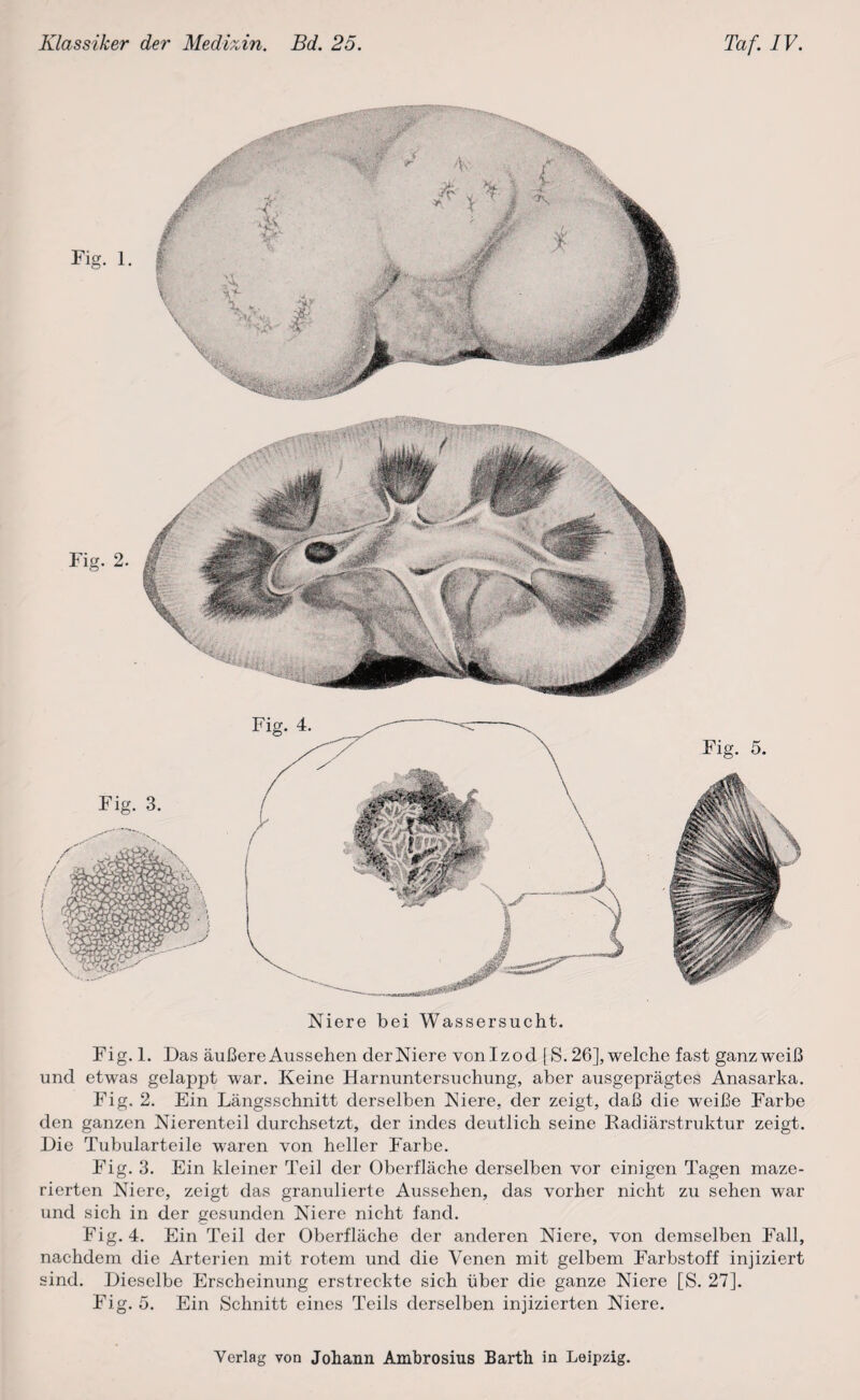 Fig. 2. Niere bei Wassersucht. Fig. 1. Das äußere Aussehen der Niere vonlzod [S. 26], welche fast ganz weiß und etwas gelappt war. Keine Harnuntersuchung, aber ausgeprägtes Anasarka. Fig. 2. Ein Längsschnitt derselben Niere, der zeigt, daß die weiße Farbe den ganzen Nierenteil durchsetzt, der indes deutlich seine Radiärstruktur zeigt. Die Tubularteile waren von heller Farbe. Fig. 3. Ein kleiner Teil der Oberfläche derselben vor einigen Tagen maze¬ rierten Niere, zeigt das granulierte Aussehen, das vorher nicht zu sehen war und sich in der gesunden Niere nicht fand. Fig. 4. Ein Teil der Oberfläche der anderen Niere, von demselben Fall, nachdem die Arterien mit rotem und die Venen mit gelbem Farbstoff injiziert sind. Dieselbe Erscheinung erstreckte sich über die ganze Niere [S. 27]. Fig. 5. Ein Schnitt eines Teils derselben injizierten Niere. Fig. 3. Fig. 4. Fig. 5.