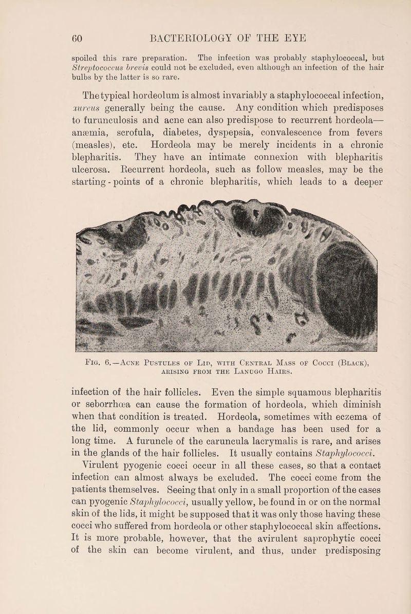 spoiled this rare preparation. The infection was probably staphylococcal, but Streptococcus brevis could not be excluded, even although an infection of the hair bulbs by the latter is so rare. The typical hordeolum is almost invariably a staphylococcal infection, aureus generally being the cause. Any condition which predisposes to furunculosis and acne can also predispose to recurrent hordeola— anaemia, scrofula, diabetes, dyspepsia, convalescence from fevers (measles), etc. Hordeola may be merely incidents in a chronic blepharitis. They have an intimate connexion with blepharitis ulcerosa. Recurrent hordeola, such as follow measles, may be the starting - points of a chronic blepharitis, which leads to a deeper Fig. 6.—Acne Pustules of Lin, with Central Mass of Cocci (Black), ARISING FROM THE LANUGO HAIRS. infection of the hair follicles. Even the simple squamous blepharitis or seborrhoea can cause the formation of hordeola, which diminish when that condition is treated. Hordeola, sometimes with eczema of the lid, commonly occur when a bandage has been used for a long time. A furuncle of the caruncula lacrymalis is rare, and arises in the glands of the hair follicles. It usually contains Staphylococci. Virulent pyogenic cocci occur in all these cases, so that a contact infection can almost always be excluded. The cocci come from the patients themselves. Seeing that only in a small proportion of the cases can pyogenic Staphylococci, usually yellow, be found in or on the normal skin of the lids, it might be supposed that it was only those having these cocci who suffered from hordeola or other staphylococcal skin affections. It is more probable, however, that the avirulent saprophytic cocci of the skin can become virulent, and thus, under predisposing