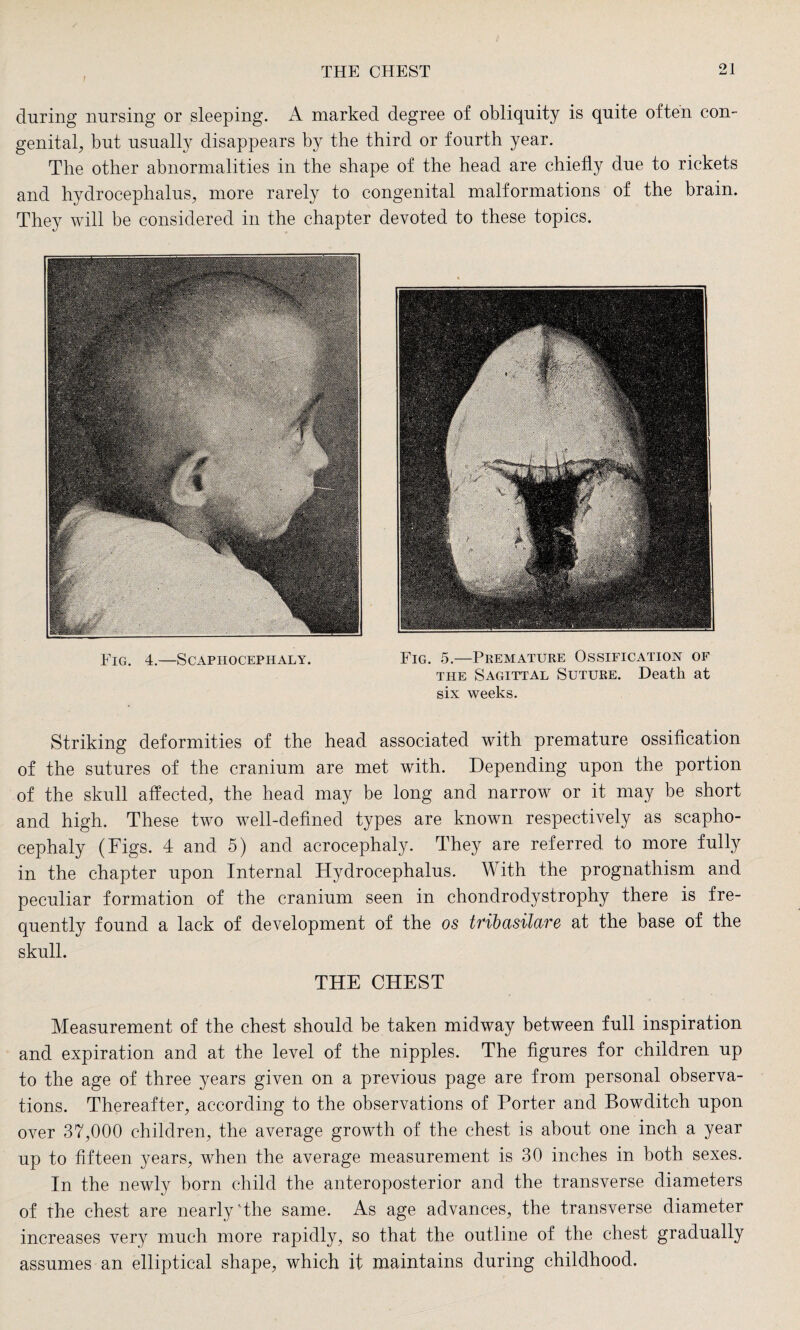 during nursing or sleeping. A marked degree of obliquity is quite often con¬ genital, but usually disappears by the third or fourth year. The other abnormalities in the shape of the head are chiefly due to rickets and hydrocephalus, more rarely to congenital malformations of the brain. They will be considered in the chapter devoted to these topics. Fig. 4.—Scaphocephaly. Fig. 5.—Premature Ossification of the Sagittal Suture. Death at six weeks. Striking deformities of the head associated with premature ossification of the sutures of the cranium are met with. Depending upon the portion of the skull affected, the head may be long and narrow or it may be short and high. These two well-defined types are known respectively as scapho¬ cephaly (Figs. 4 and 5) and acrocephaly. They are referred to more fully in the chapter upon Internal Hydrocephalus. With the prognathism and peculiar formation of the cranium seen in chondrodystrophy there is fre¬ quently found a lack of development of the os tribasilare at the base of the skull. THE CHEST Measurement of the chest should be taken midway between full inspiration and expiration and at the level of the nipples. The figures for children up to the age of three years given on a previous page are from personal observa¬ tions. Thereafter, according to the observations of Porter and Bowditch upon over 37,000 children, the average growth of the chest is about one inch a year up to fifteen years, when the average measurement is 30 inches in both sexes. In the newly born child the anteroposterior and the transverse diameters of the chest are nearly' the same. As age advances, the transverse diameter increases very much more rapidly, so that the outline of the chest gradually assumes an elliptical shape, which it maintains during childhood.