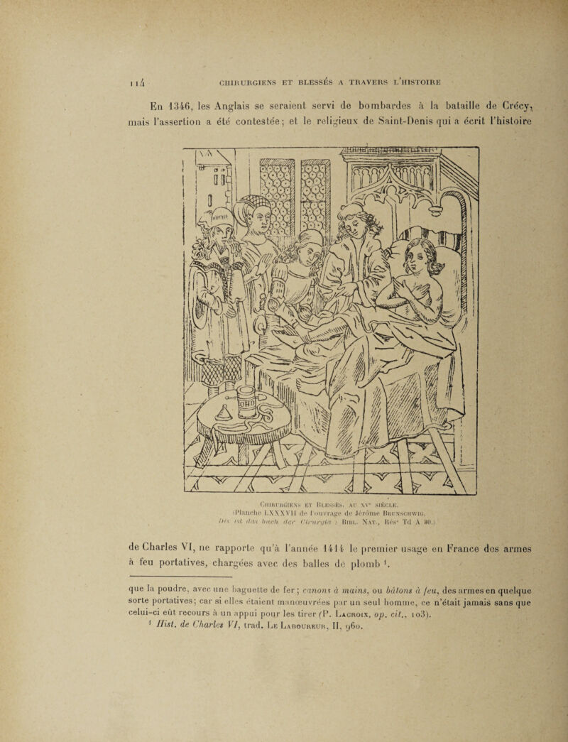 Eli 1346, les Anglais se seraient servi de bombardes à la bataille de Crécy, mais l’assertion a été contestée; et le religieux de Saint-Denis qui a écrit l’histoire Chirurgiens et Blessés, au \v1, siècle. (Planche LXXXV1I de l'ouvrage de Jérôme Bbunschwig, />t\ ist dus Intch der (Hrurt/ià : Bibl- Nat., Hésr Td A *0.) de Charles VI, ne rapporte qu’à l’année 1414 le premier usage en France dos armes à feu portatives, chargées avec des balles de plomb * 1. que la poudre, avec une baguette de fer ; canons à mains, ou bâtons à feu, des armes en quelque sorte portatives; car si elles étaient manœuvrées par un seul homme, ce n’était jamais sans que celui-ci eût recours à un appui pour les tirer (P. Lacroix, op. cit., io3). 1 Jfist. de Charles 17, trad. Le Laboureur, II, q6o.