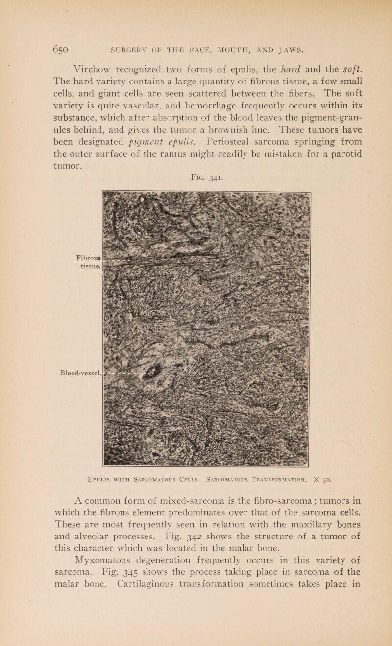 Virchow recognized two forms of epulis, the hard and the soft. The hard variety contains a large quantity of fibrous tissue, a few small cells, and giant cells are seen scattered between the fibers. The soft variety is quite vascular, and hemorrhage frequently occurs within its substance, which after absorption of the blood leaves the pigment-gran¬ ules behind, and gives the tumor a brownish hue. These tumors have been designated pigment epulis. Periosteal sarcoma springing from the outer surface of the ramus might readily be mistaken for a parotid tumor. Fig. 341. Fibrous tissue. Blood-vessel, Epulis with Sarcomatous Cells. Sarcomatous Transformation. X 50. A common form of mixed-sarcoma is the fibro-sarcoma; tumors in which the fibrous element predominates over that of the sarcoma cells. These are most frequently seen in relation with the maxillary bones and alveolar processes. Fig. 342 shows the structure of a tumor of this character which was located in the malar bone. Myxomatous degeneration frequently occurs in this variety of sarcoma. Fig. 345 shows the process taking place in sarcoma of the malar bone. Cartilaginous transformation sometimes takes place in